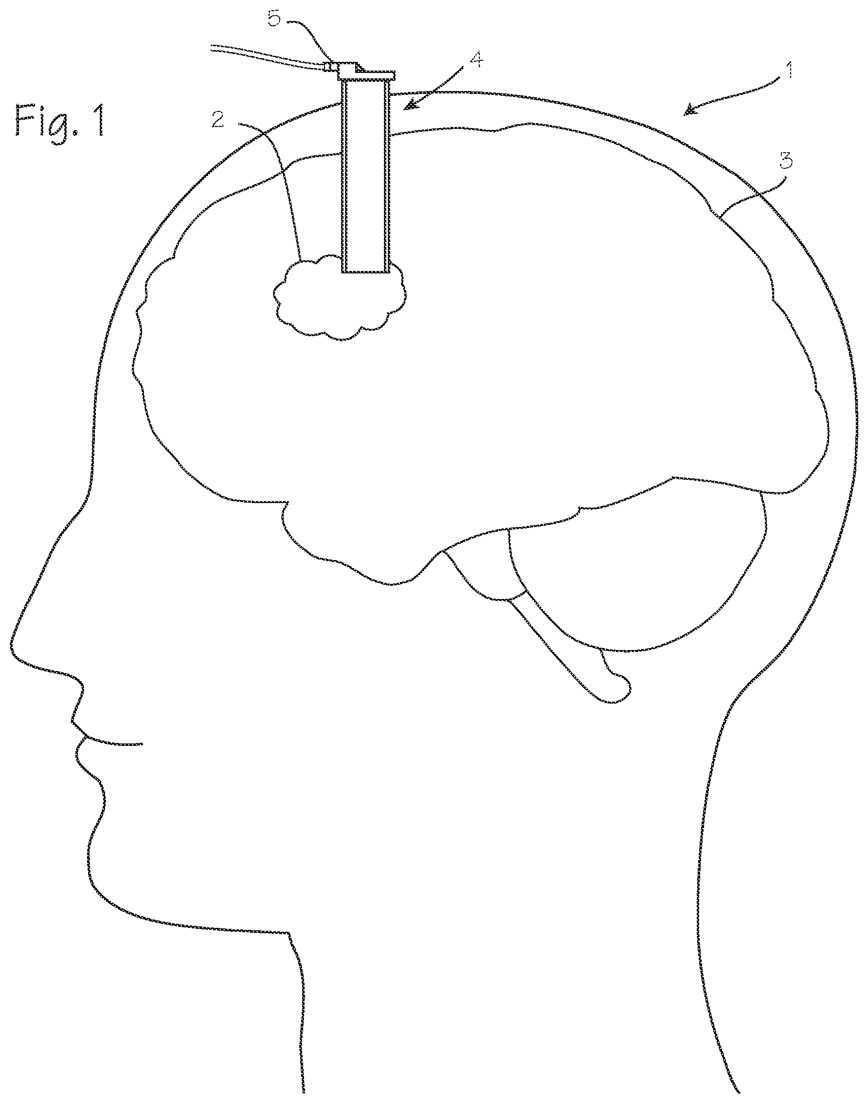 Patent US11779201 — Cannula with proximally mounted camera and transparent obturator — Figure 1