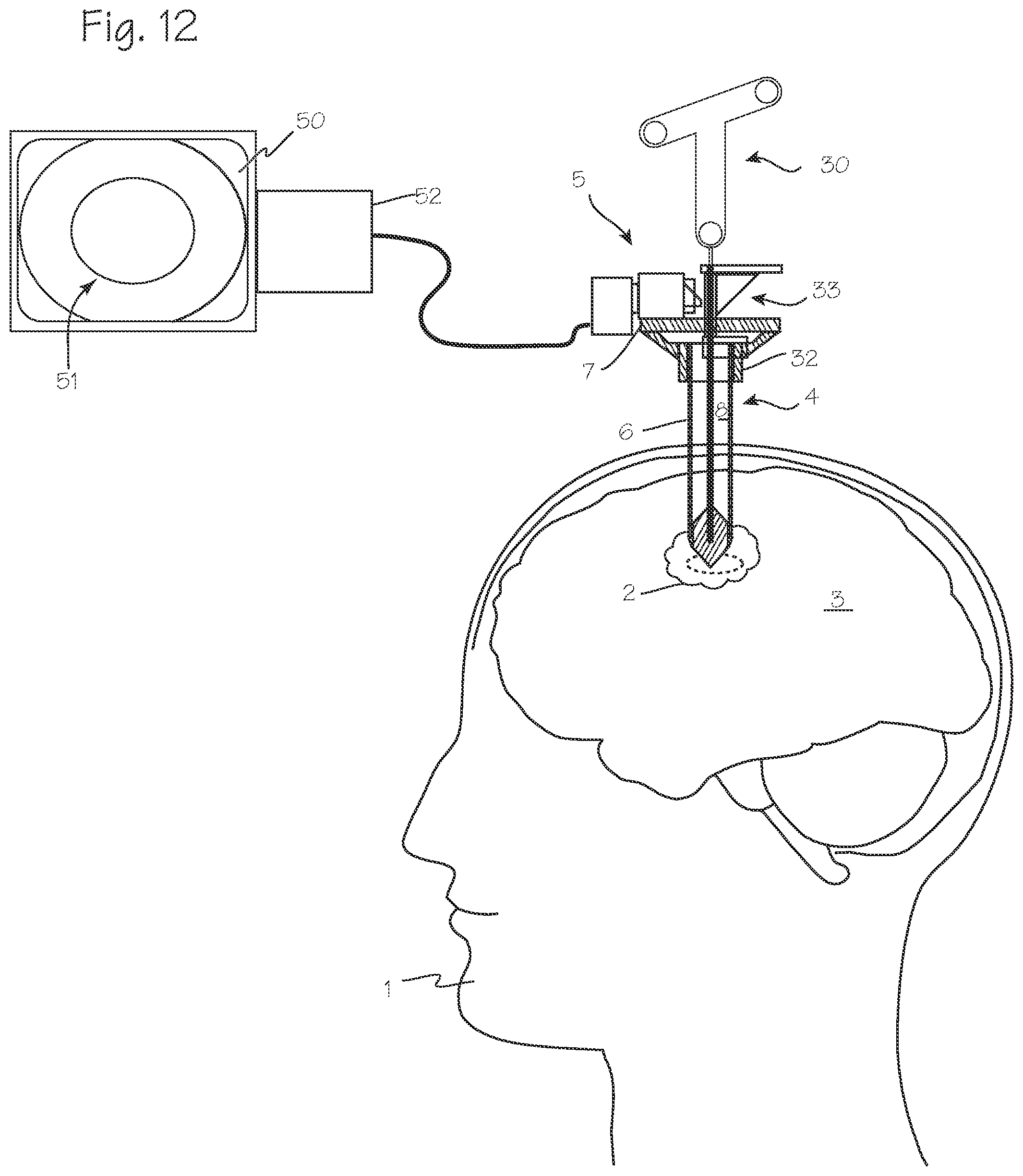 Patent US11779201 Figure 5 – Cannula with proximally mounted camera and transparent obturator
