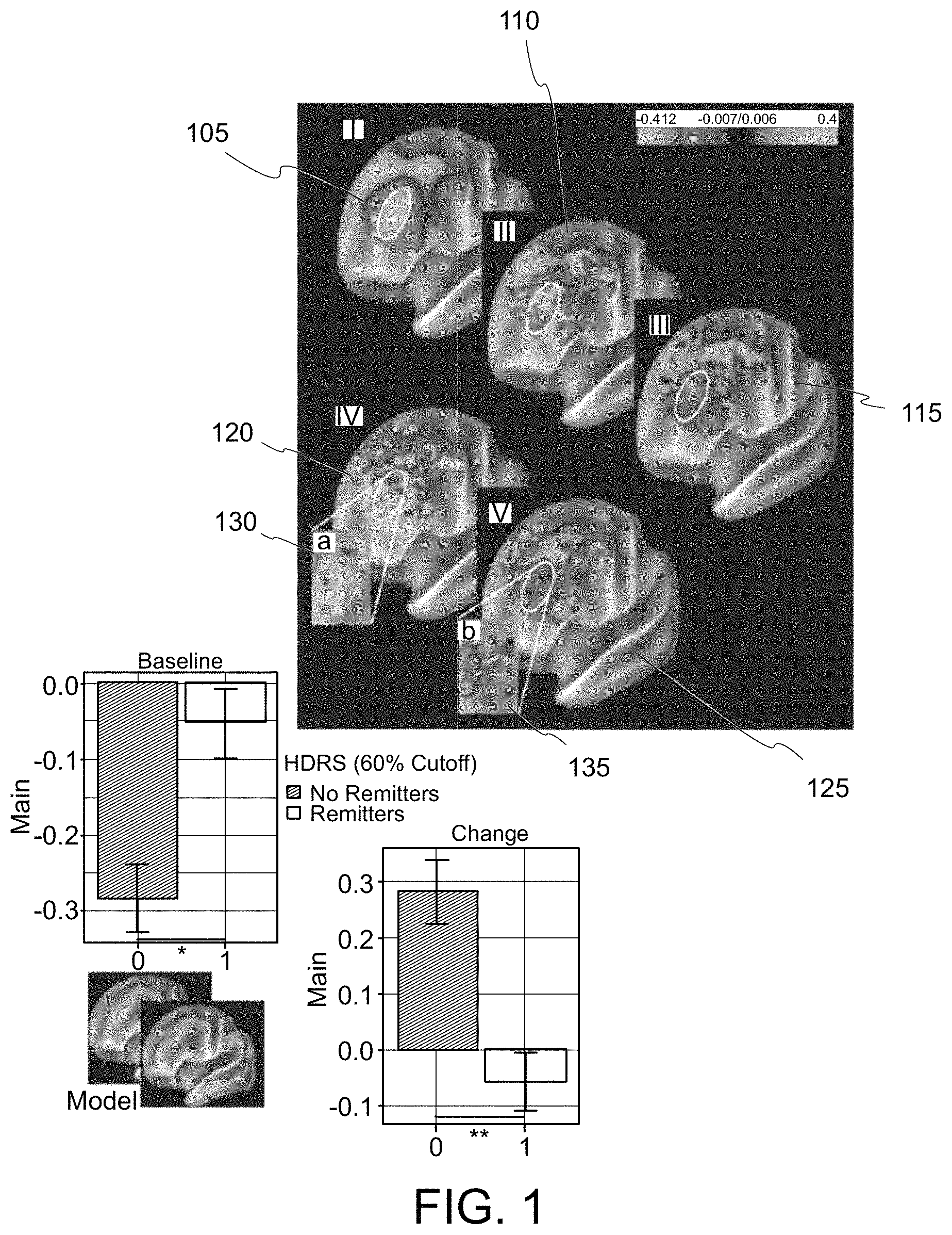 Patent US11779218 Figure 1 – System, method and computer-accessible medium for predicting response to electroconvulsice therapy based on brain functional connectivity patterns