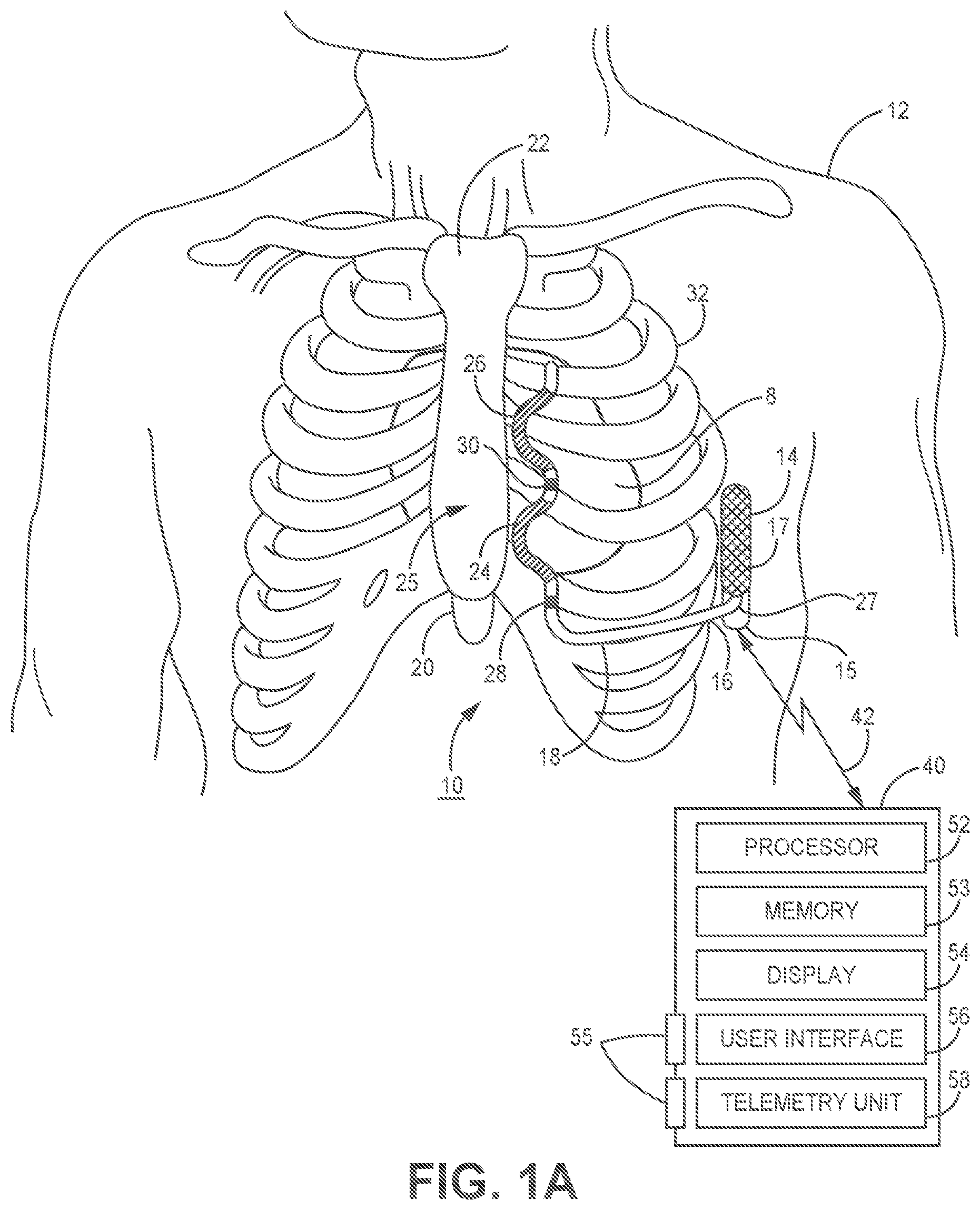 Patent US11779255 Figure 1 – Medical device and method for predicting cardiac event sensing based on sensing control parameters