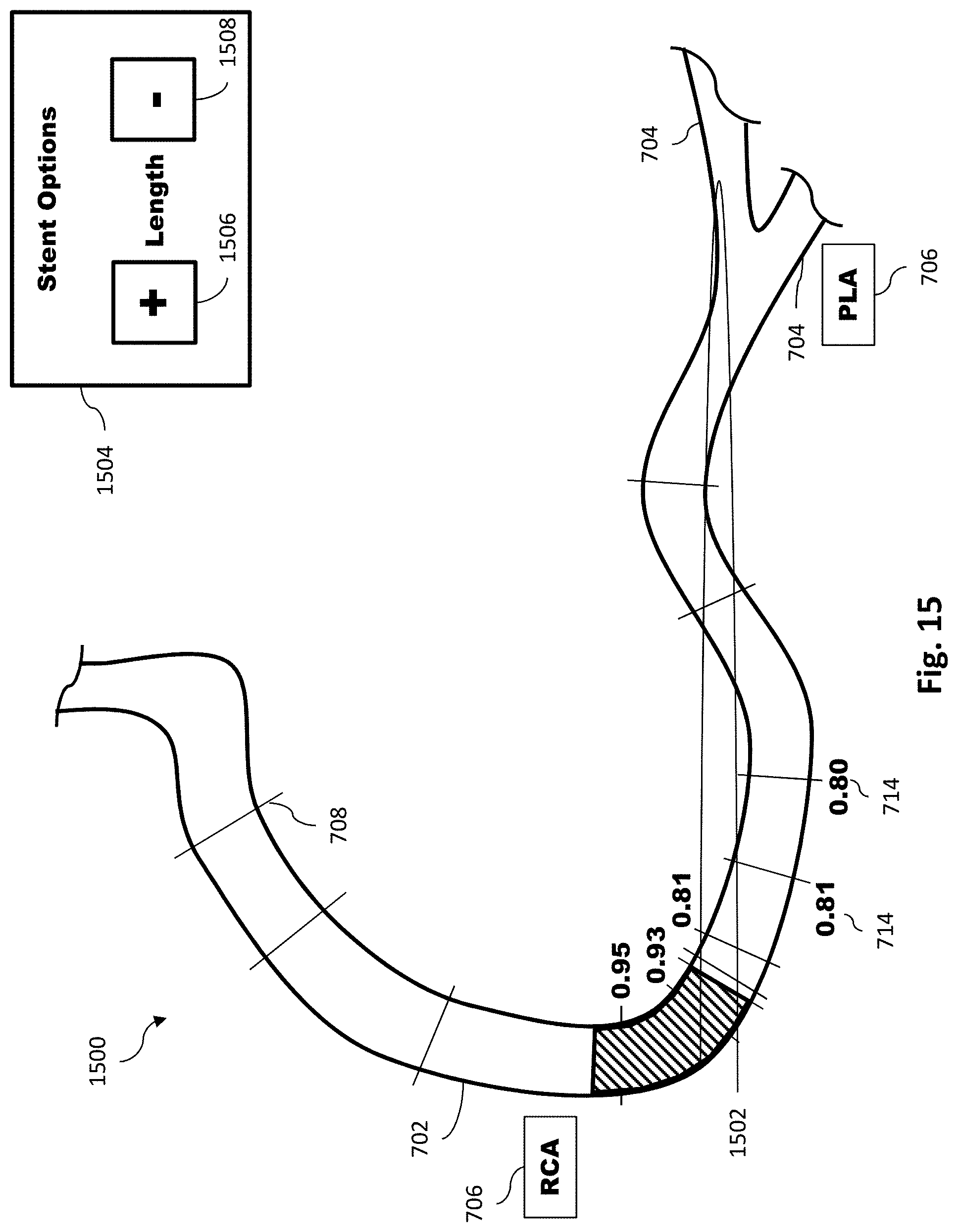 Patent US11779286 Figure 16 – Percutaneous coronary intervention (PCI) planning interface with pressure data and vessel data and associated devices, systems, and methods