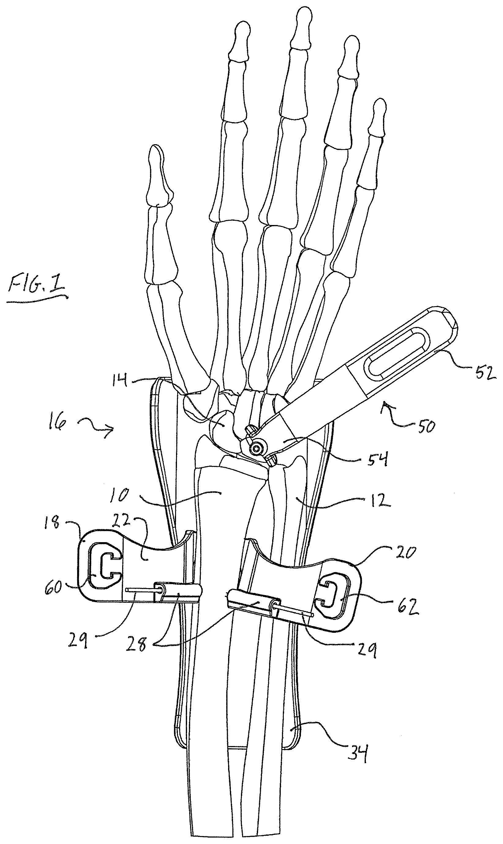 Patent US11779323 — Single use radiolucent stabilizing retractor system — Figure 1