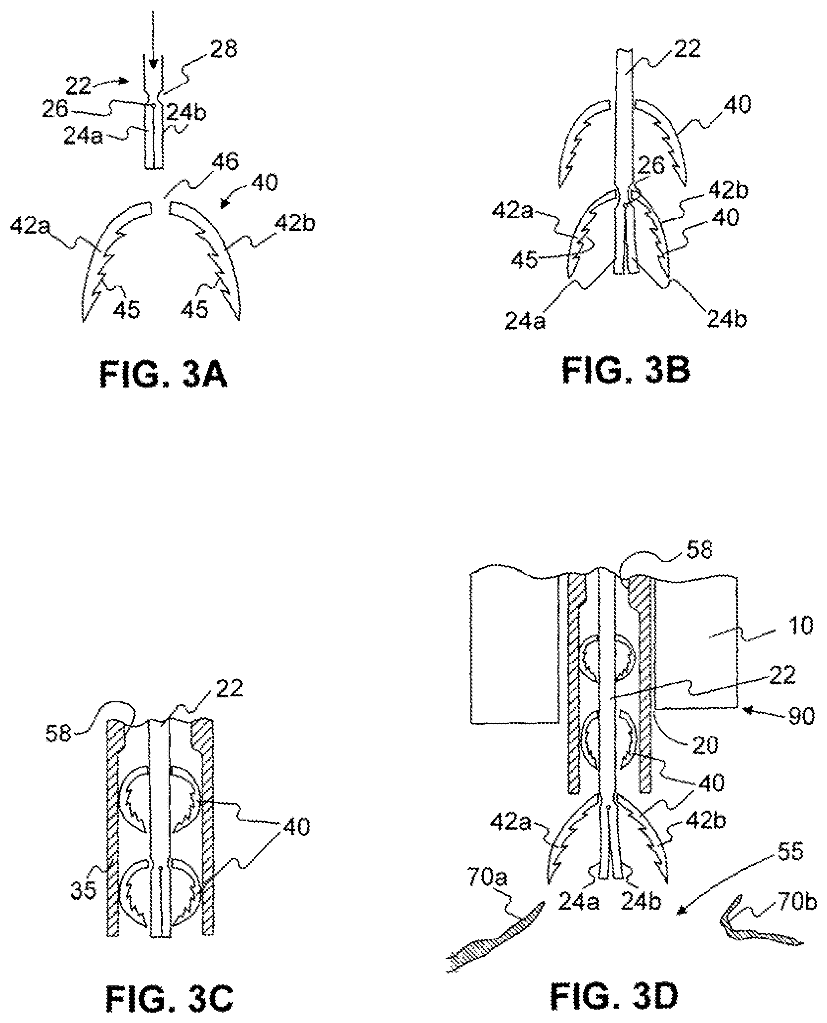 Patent US11779338 Figure 3 – Devices for approximating tissue and related