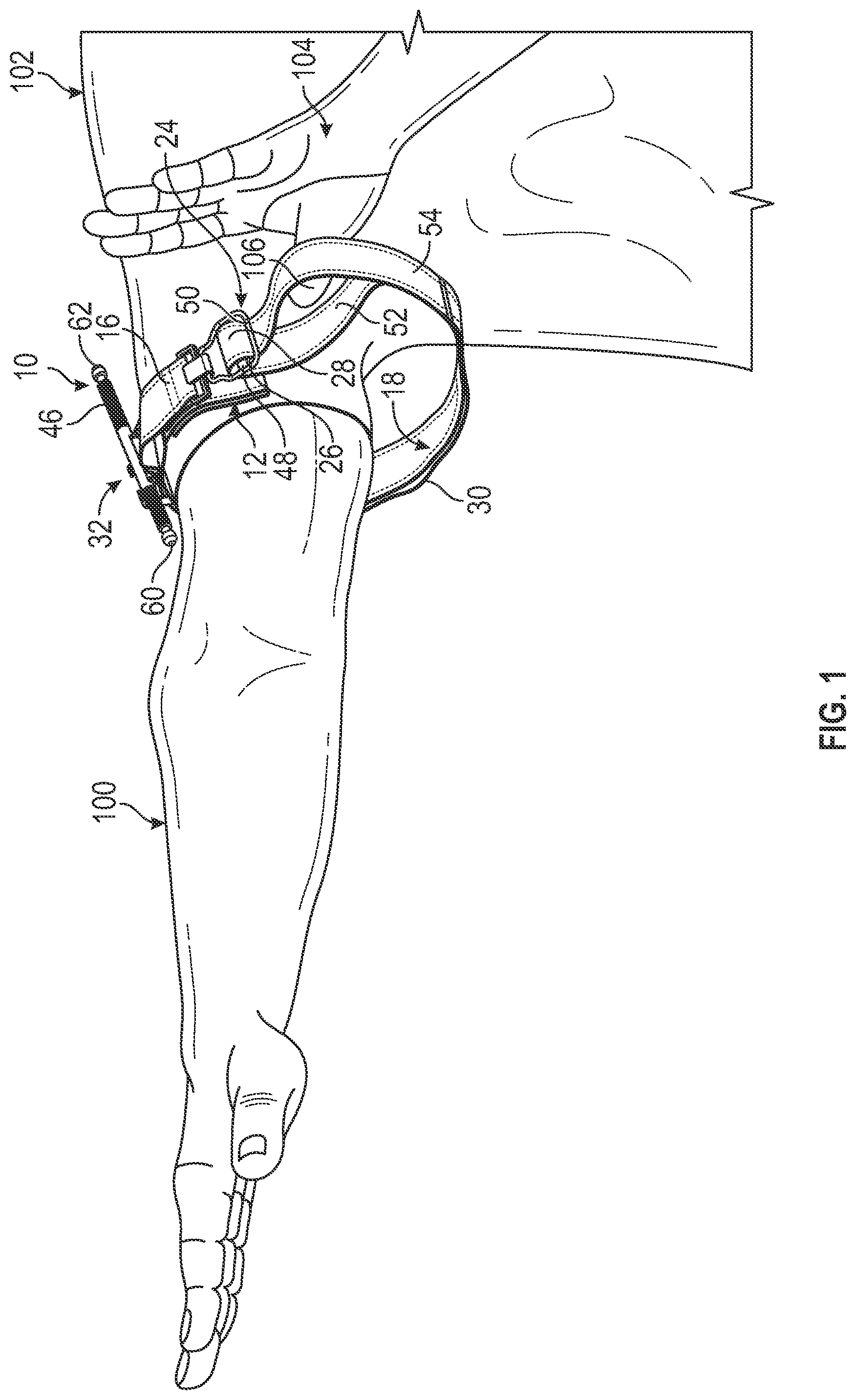 Patent US11779345 — Tourniquet — Figure 1