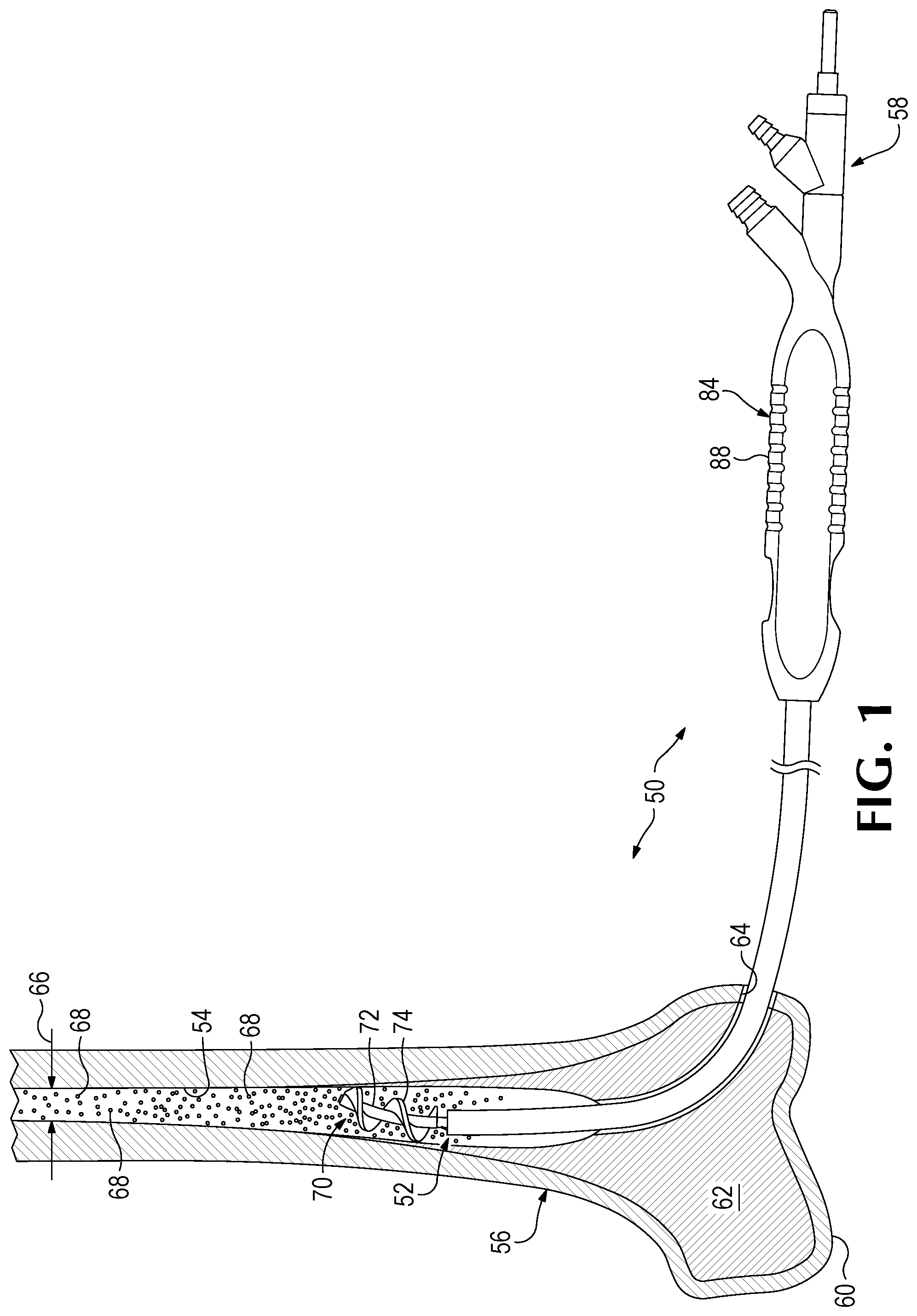 Patent US11779350 — Bone harvesting system — Figure 1