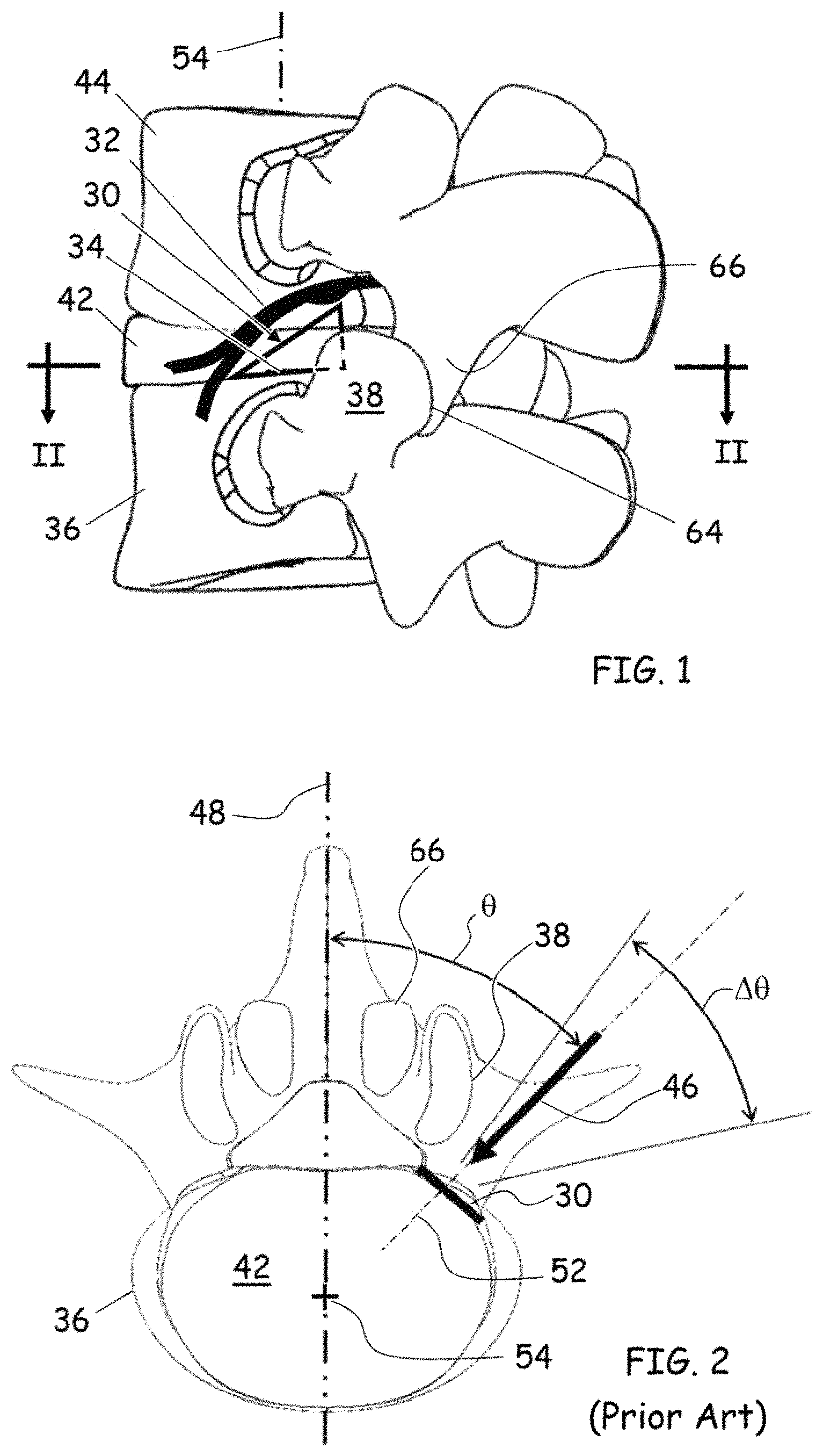 Patent US11779352 — Trans-facet oblique lateral lumbar interbody fusion — Figure 1
