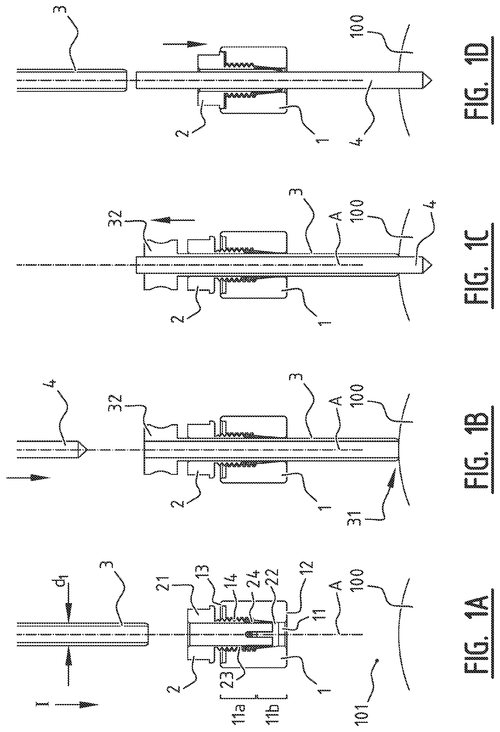 Patent US11779355 — System for connecting a connecting device, in particular a distractor, to a bone — Figure 1