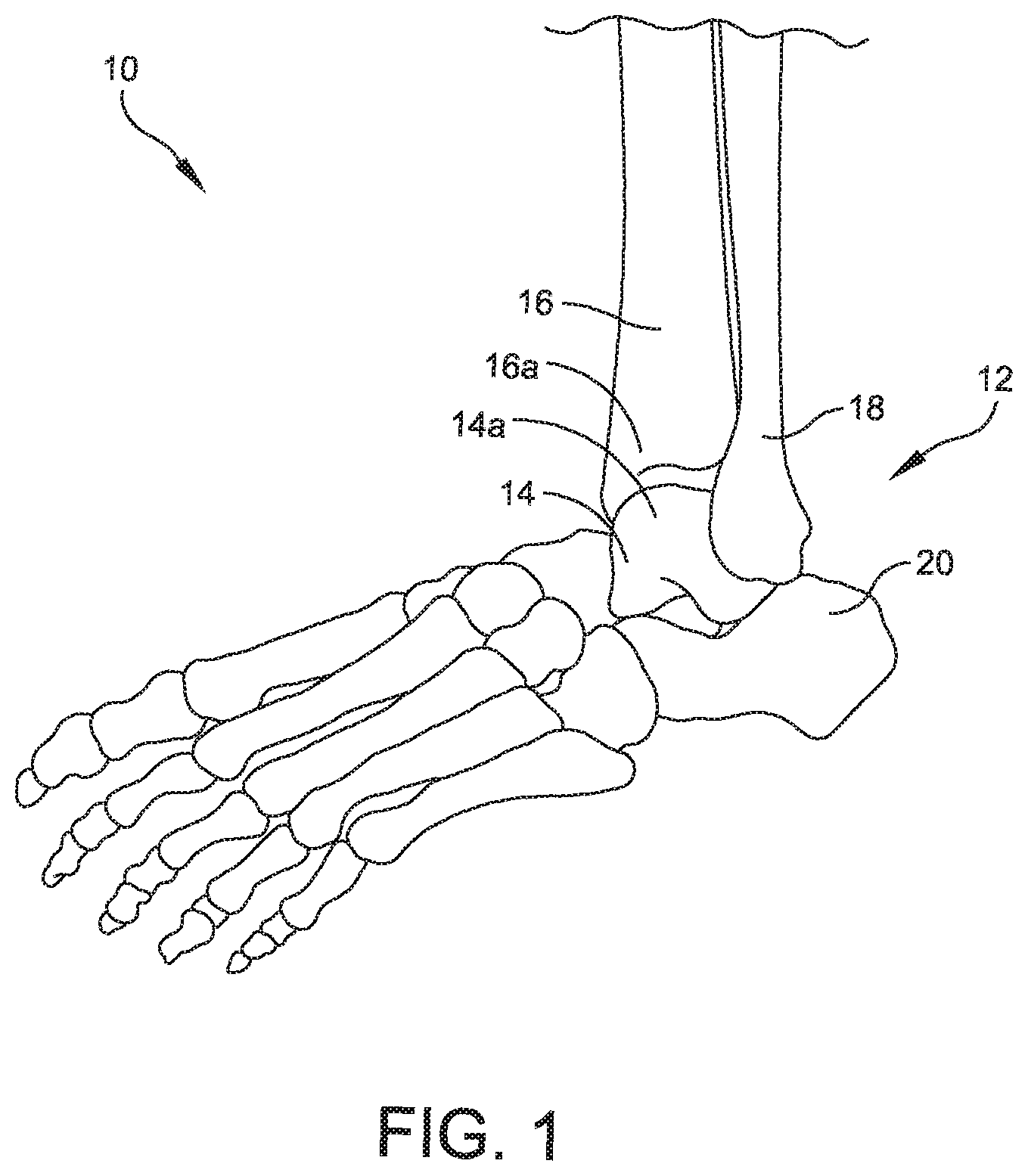 Patent US11779356 Figure 1 – Orthopedic surgical guide