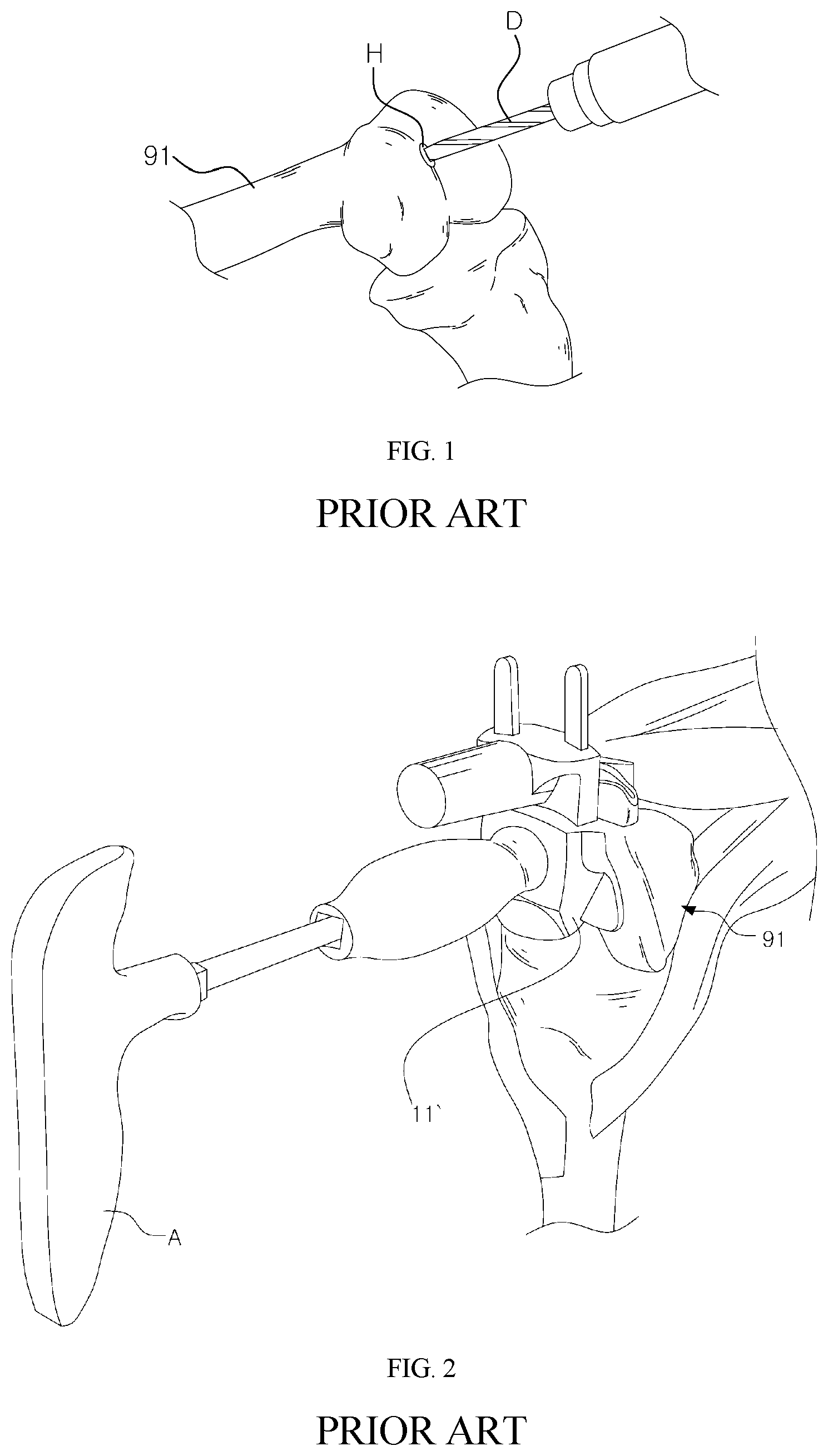 Patent US11779357 — Detector for artificial joint replacement — Figure 1