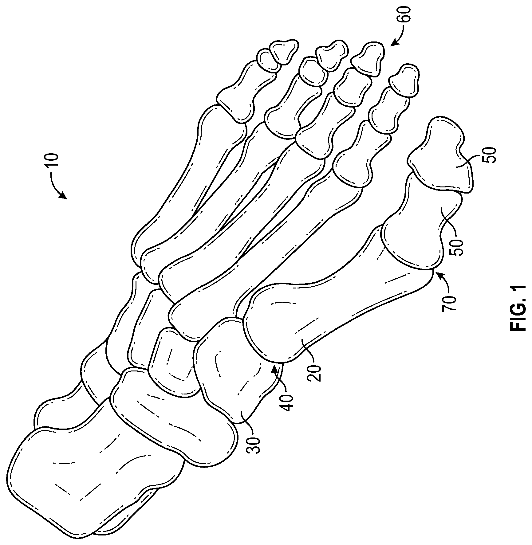 Patent US11779359 — Systems and methods for Lapidus repair of bunions — Figure 1