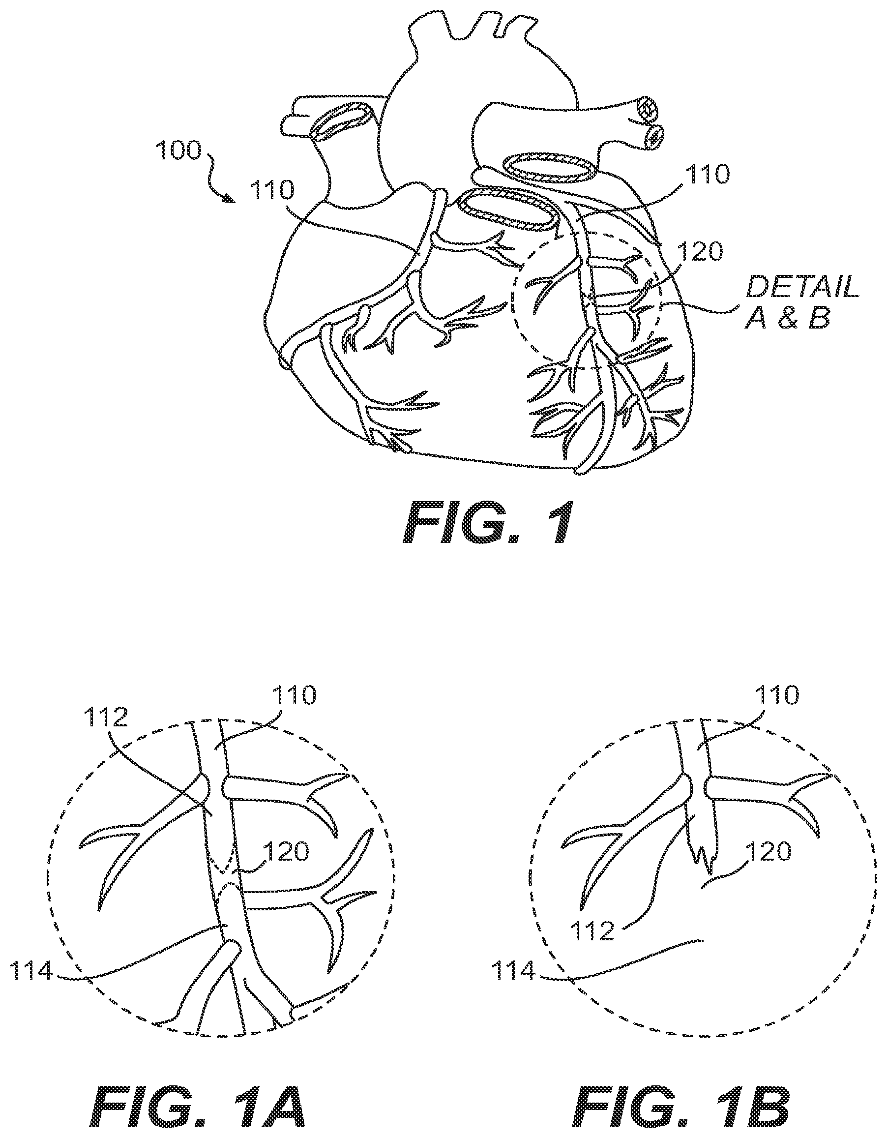 Patent US11779361 — Endovascular devices and methods for exploiting intramural space — Figure 1