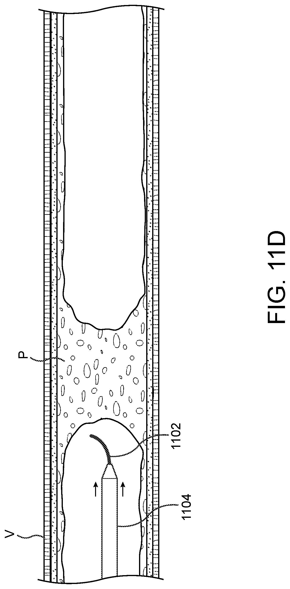 Patent US11779362 Figure 14 – Methods and apparatus for true lumen re-entry