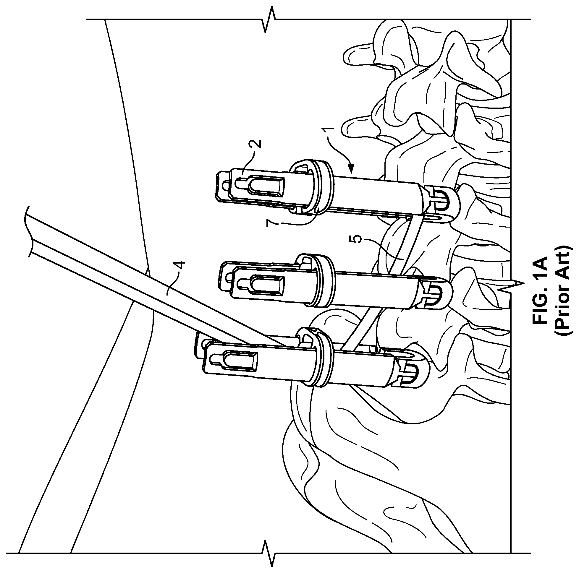 Patent US11779377 — Systems and methods for percutaneous spinal fusion — Figure 1