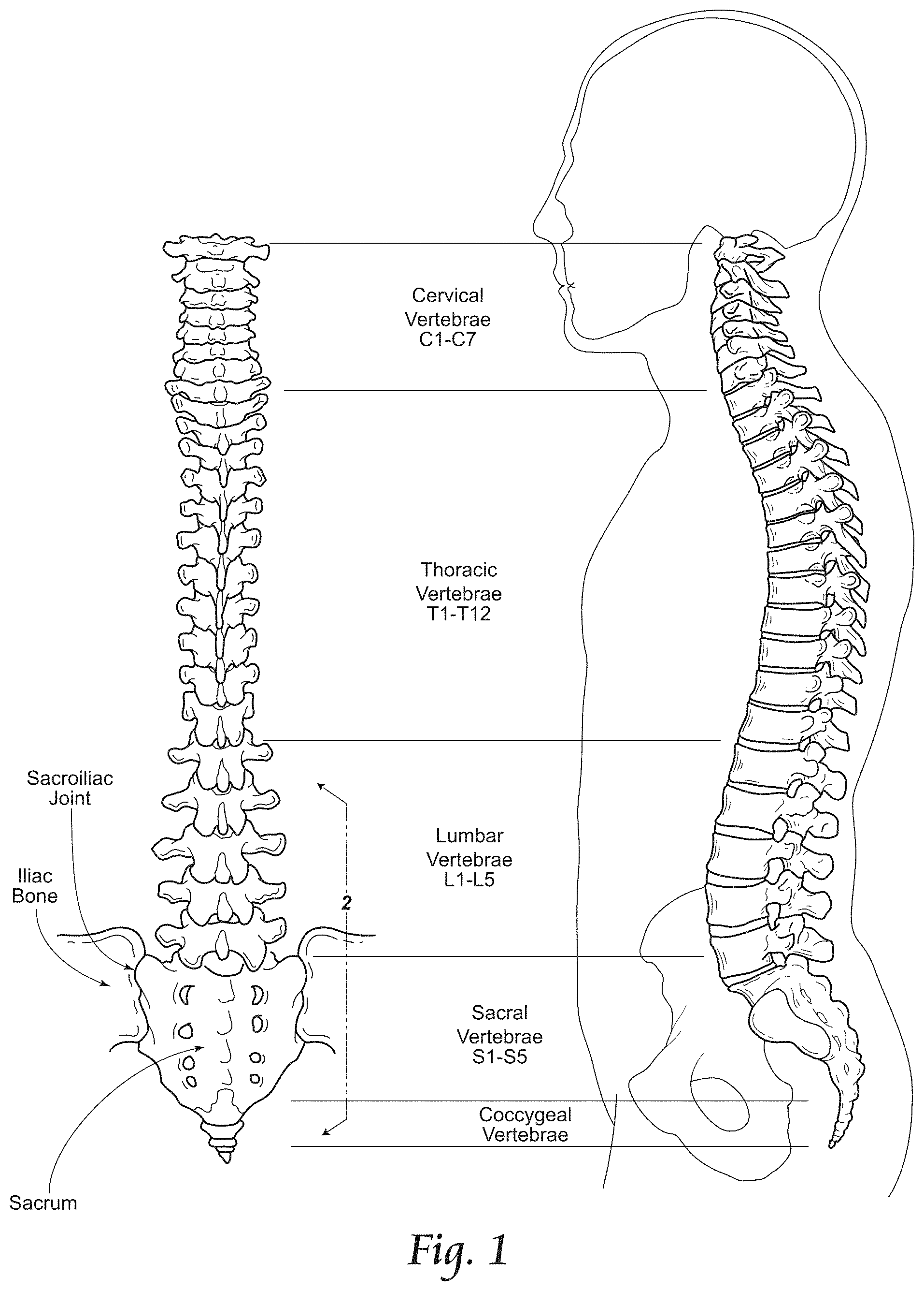 Patent US11779380 — Methods, systems, and devices for the treatment of stenosis — Figure 1