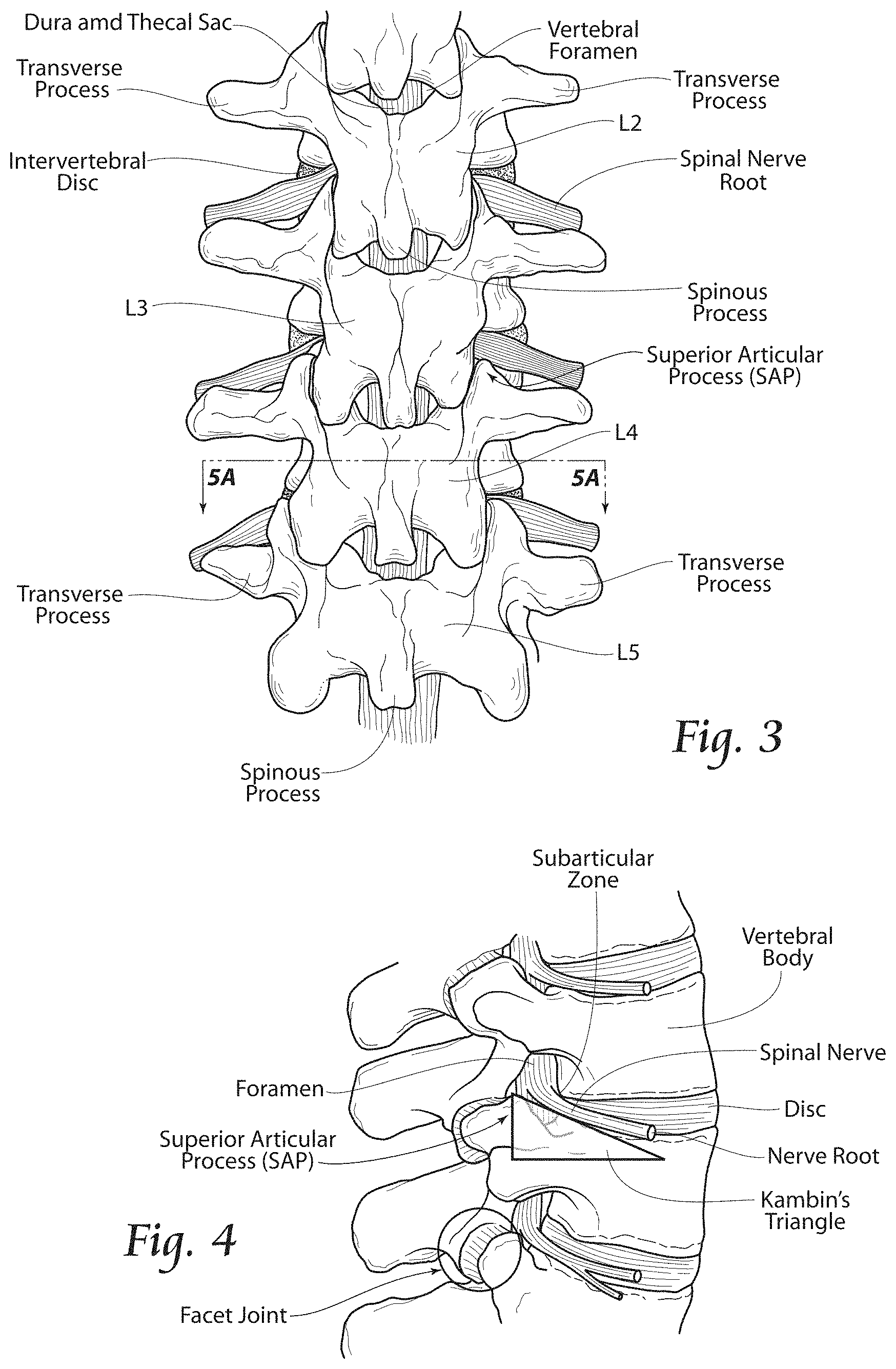 Patent US11779380 Figure 3 – Methods, systems, and devices for the treatment of stenosis