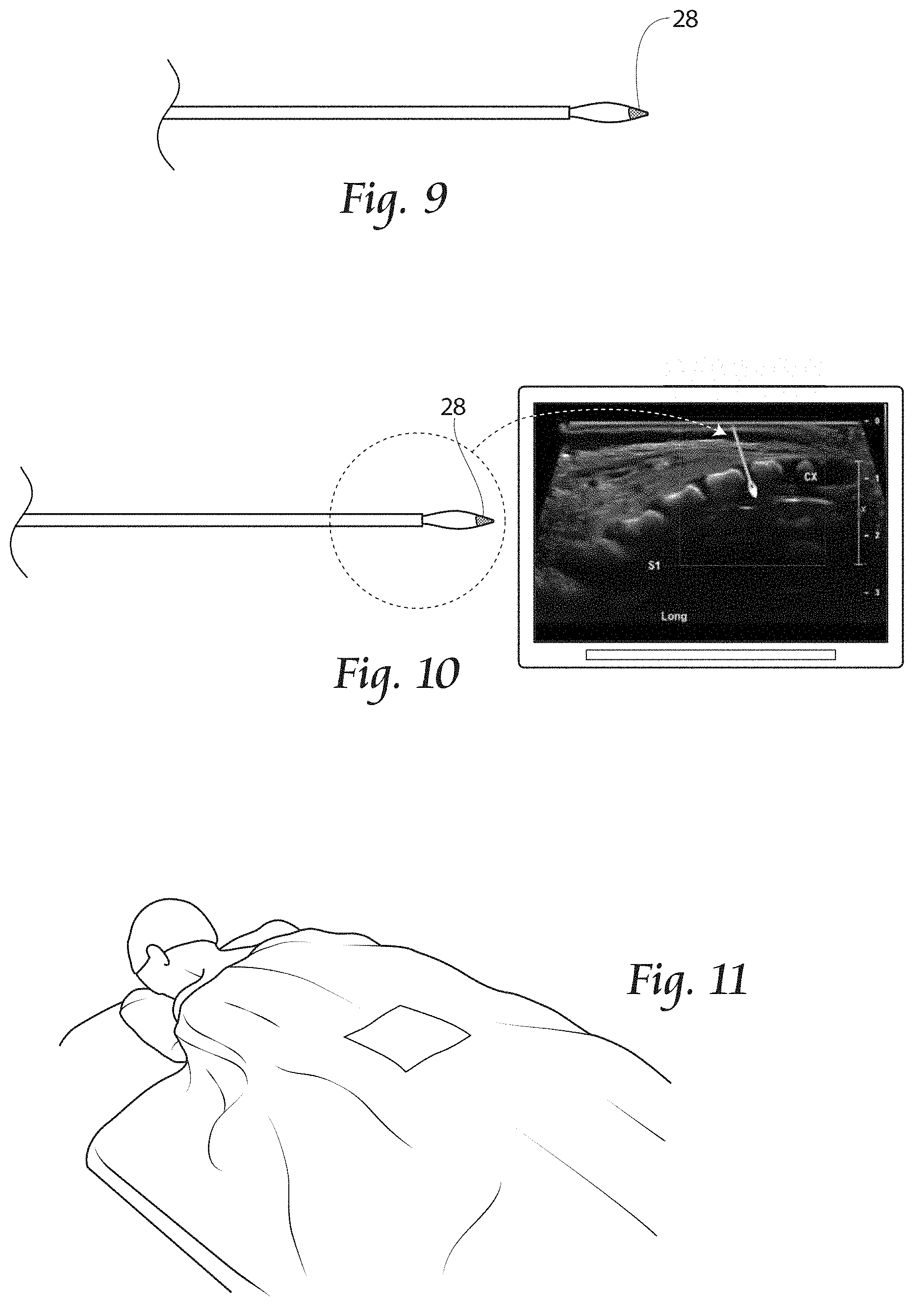 Patent US11779380 Figure 6 – Methods, systems, and devices for the treatment of stenosis