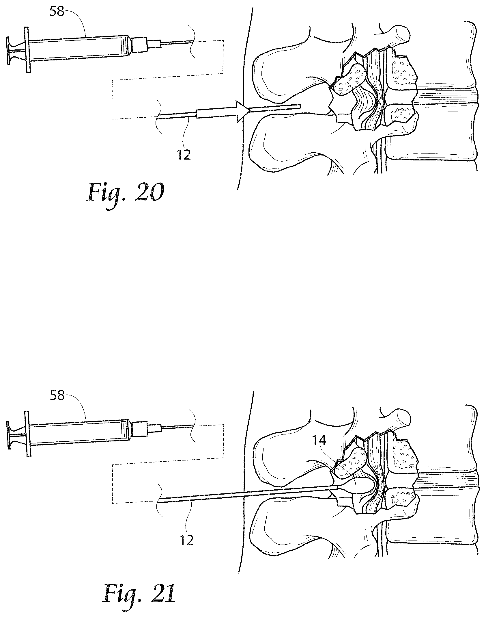 Patent US11779380 Figure 10 – Methods, systems, and devices for the treatment of stenosis