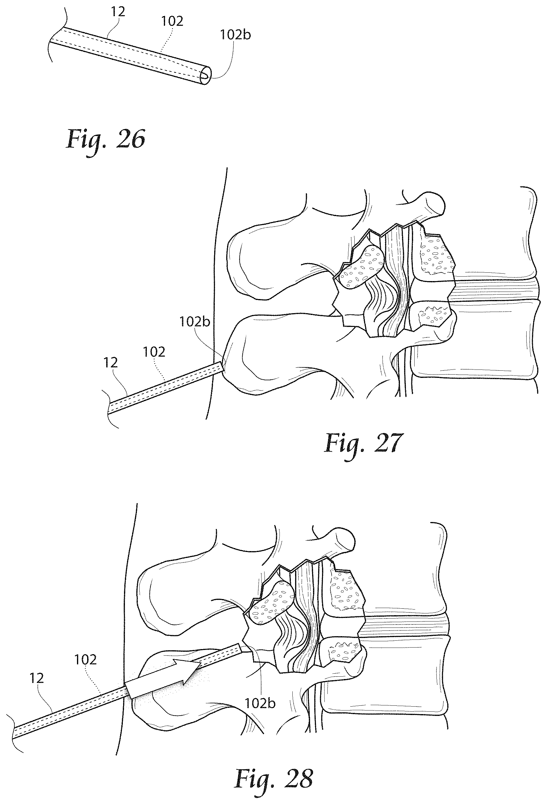 Patent US11779380 Figure 13 – Methods, systems, and devices for the treatment of stenosis