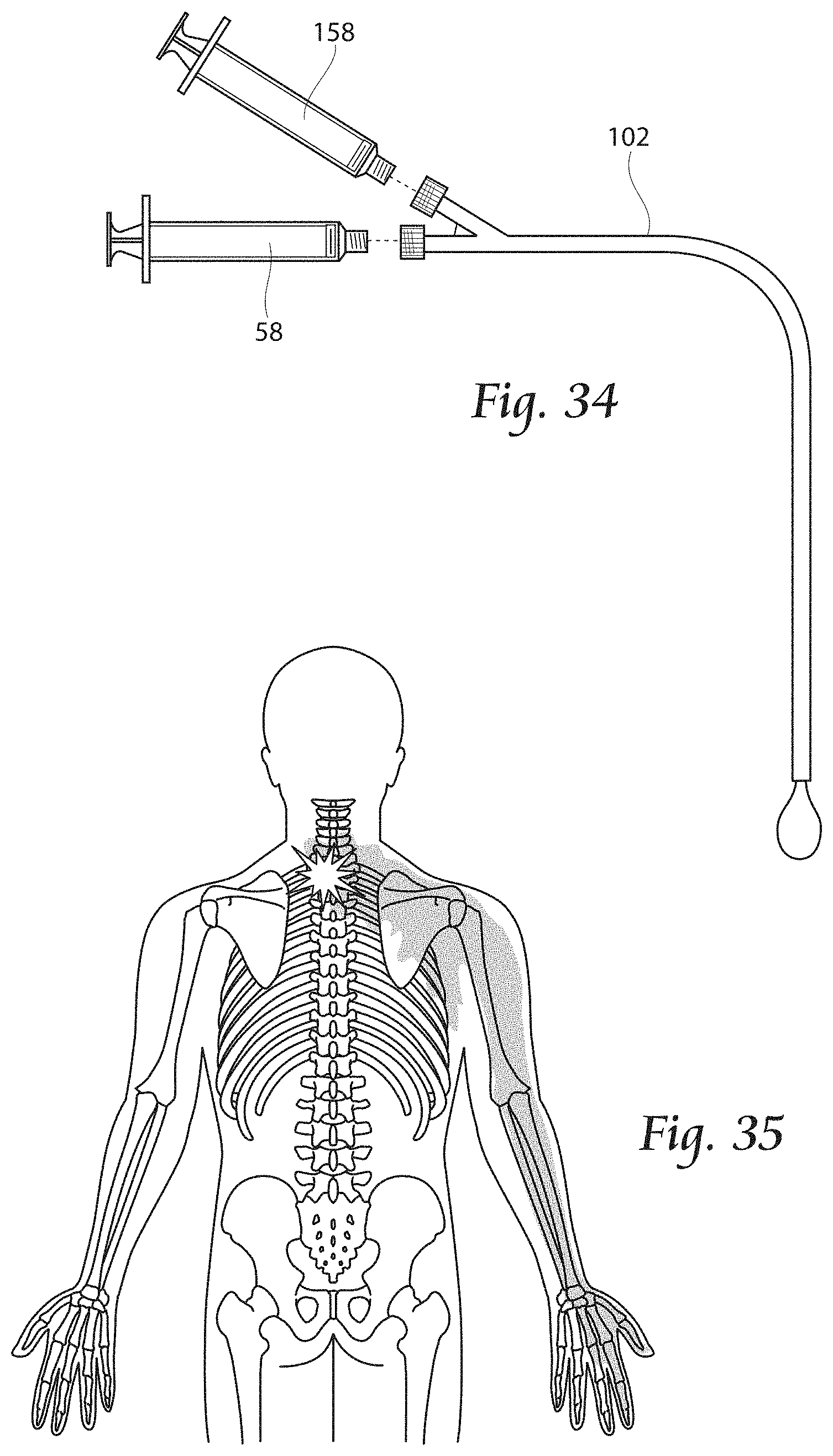 Patent US11779380 Figure 16 – Methods, systems, and devices for the treatment of stenosis