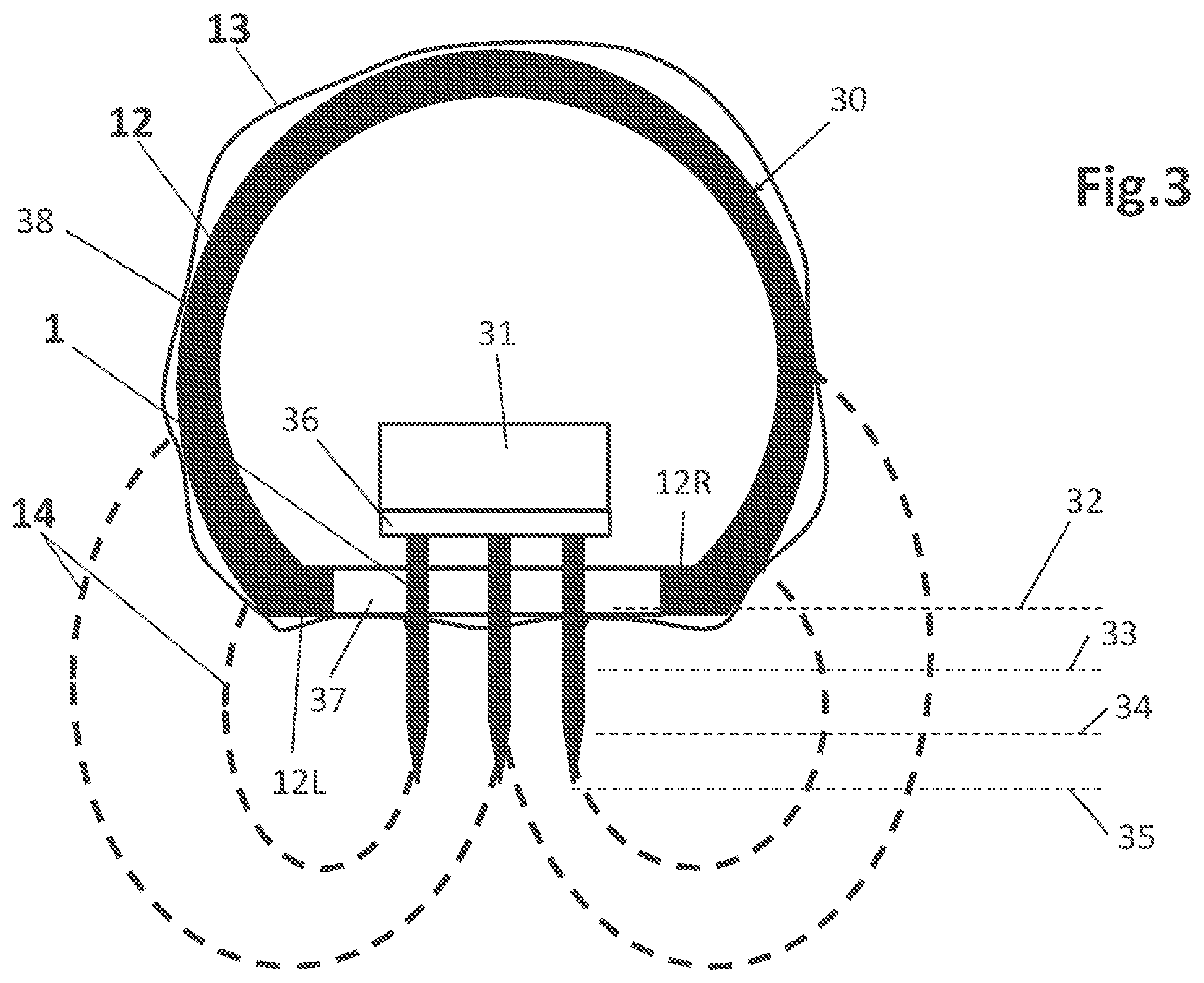 Patent US11779388 Figure 3 – RF fractional device for treatment at different tissue depths
