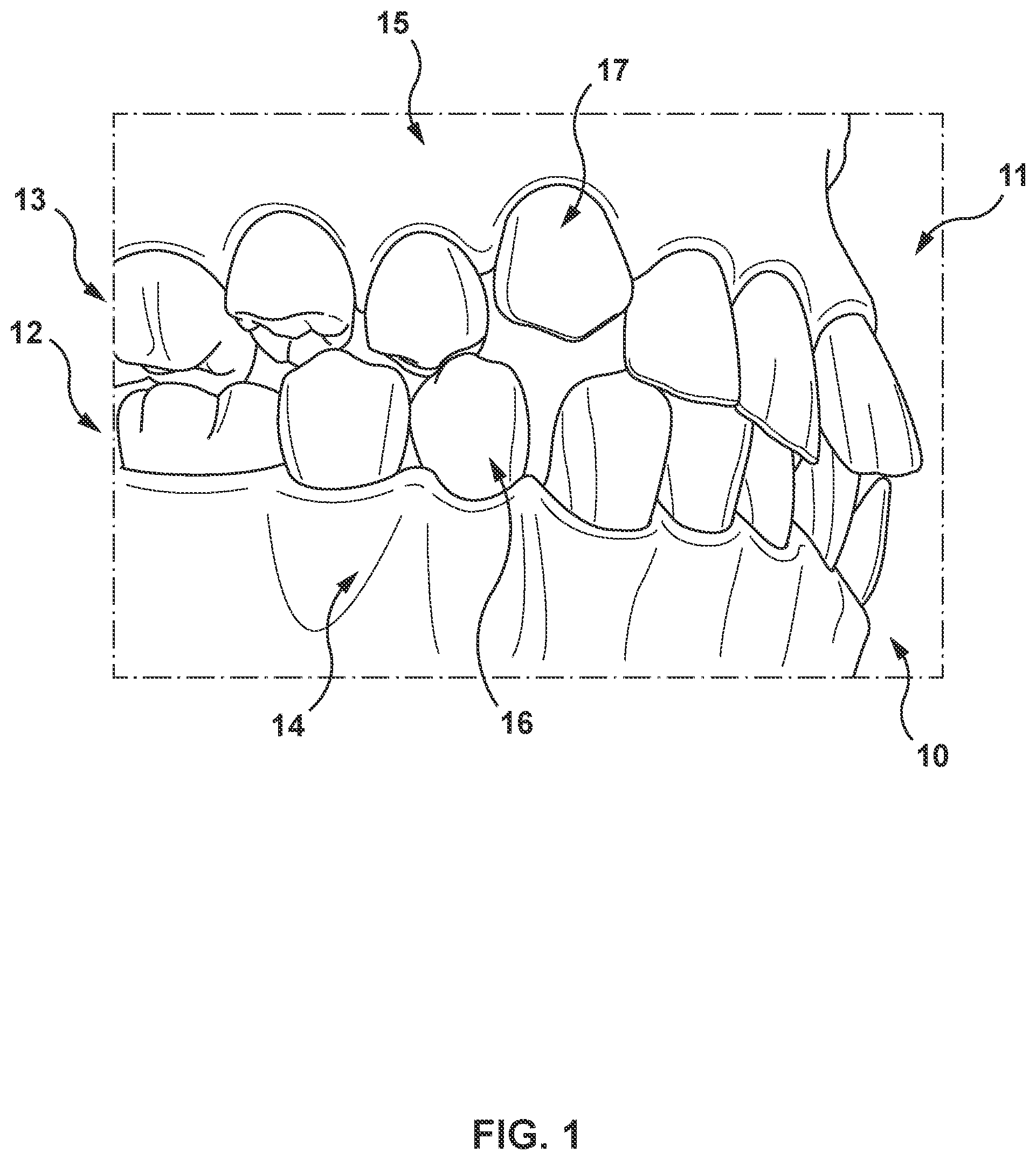Patent US11779445 Figure 1 – Systems and methods for determining a bite position between teeth of a subject