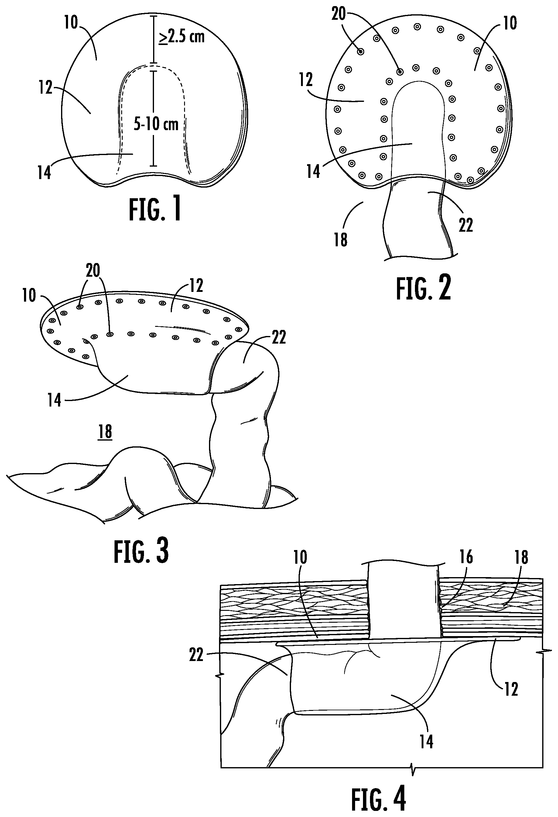 Patent US11779448 — Pre-formed parastomal hernia reinforcement mesh — Figure 1
