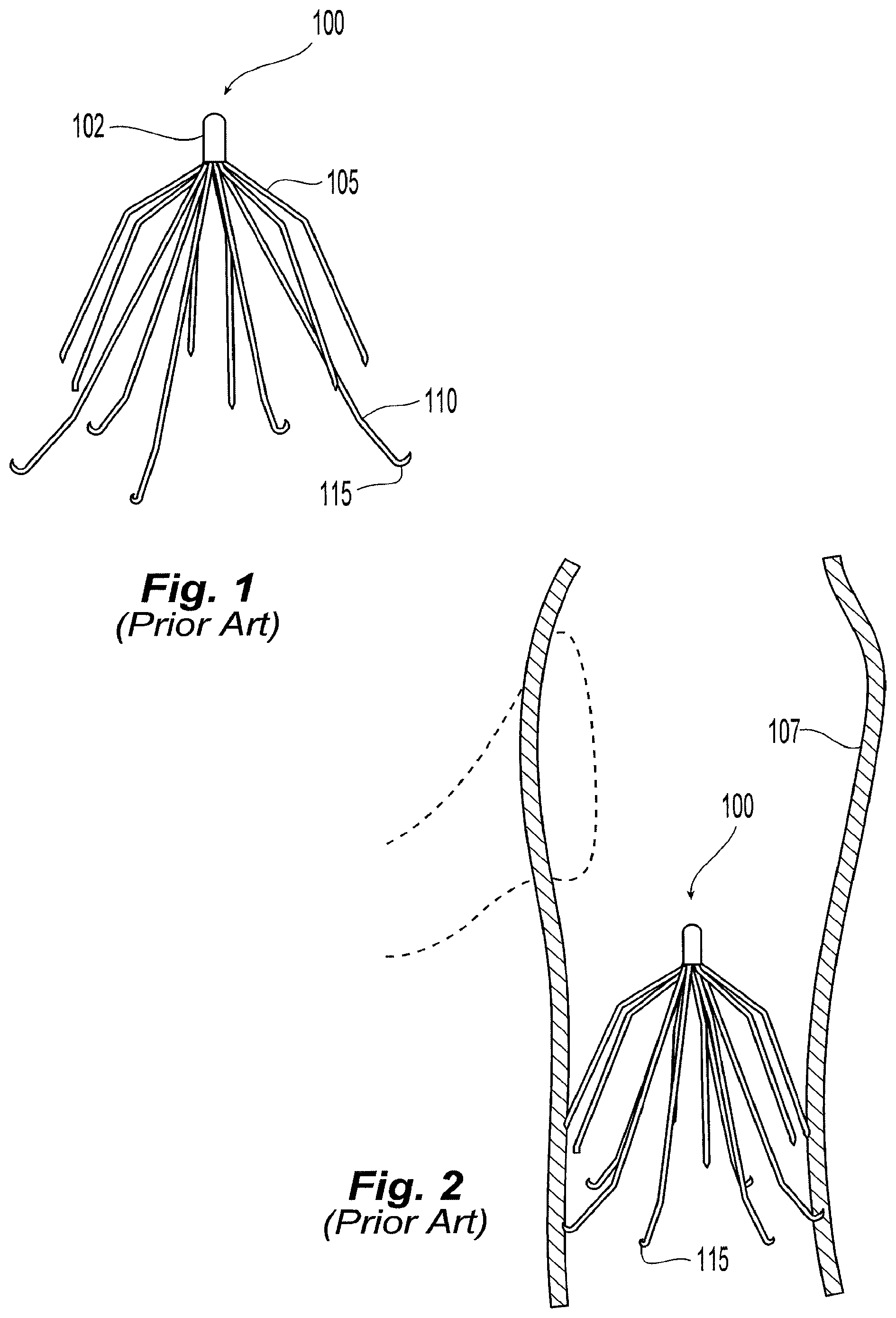 Patent US11779449 — Inferior vena cava filter with stability features — Figure 1