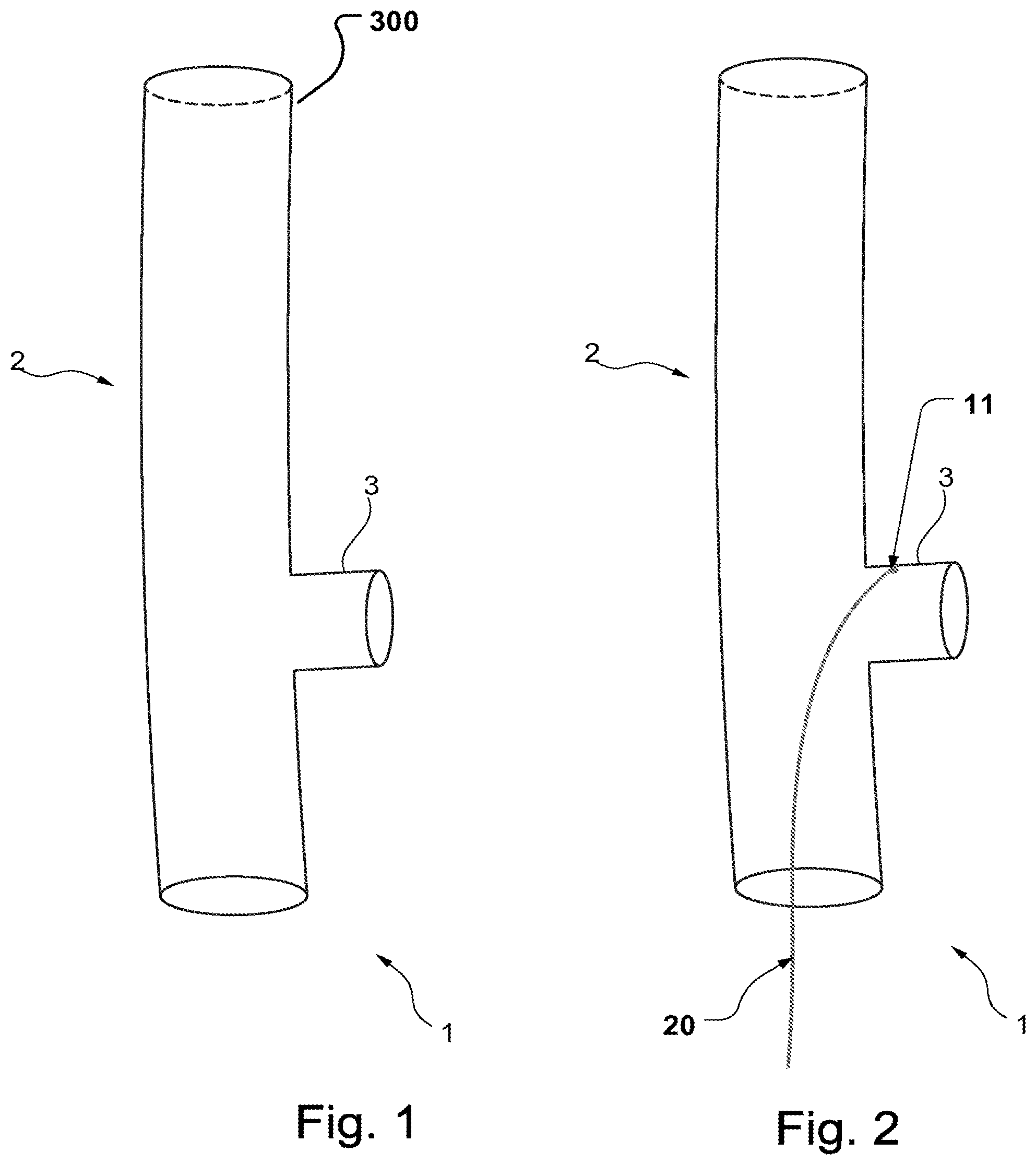 Patent US11779453 — Stent-graft prosthesis, system and method for improved delivery of a stent-graft prosthesis — Figure 1
