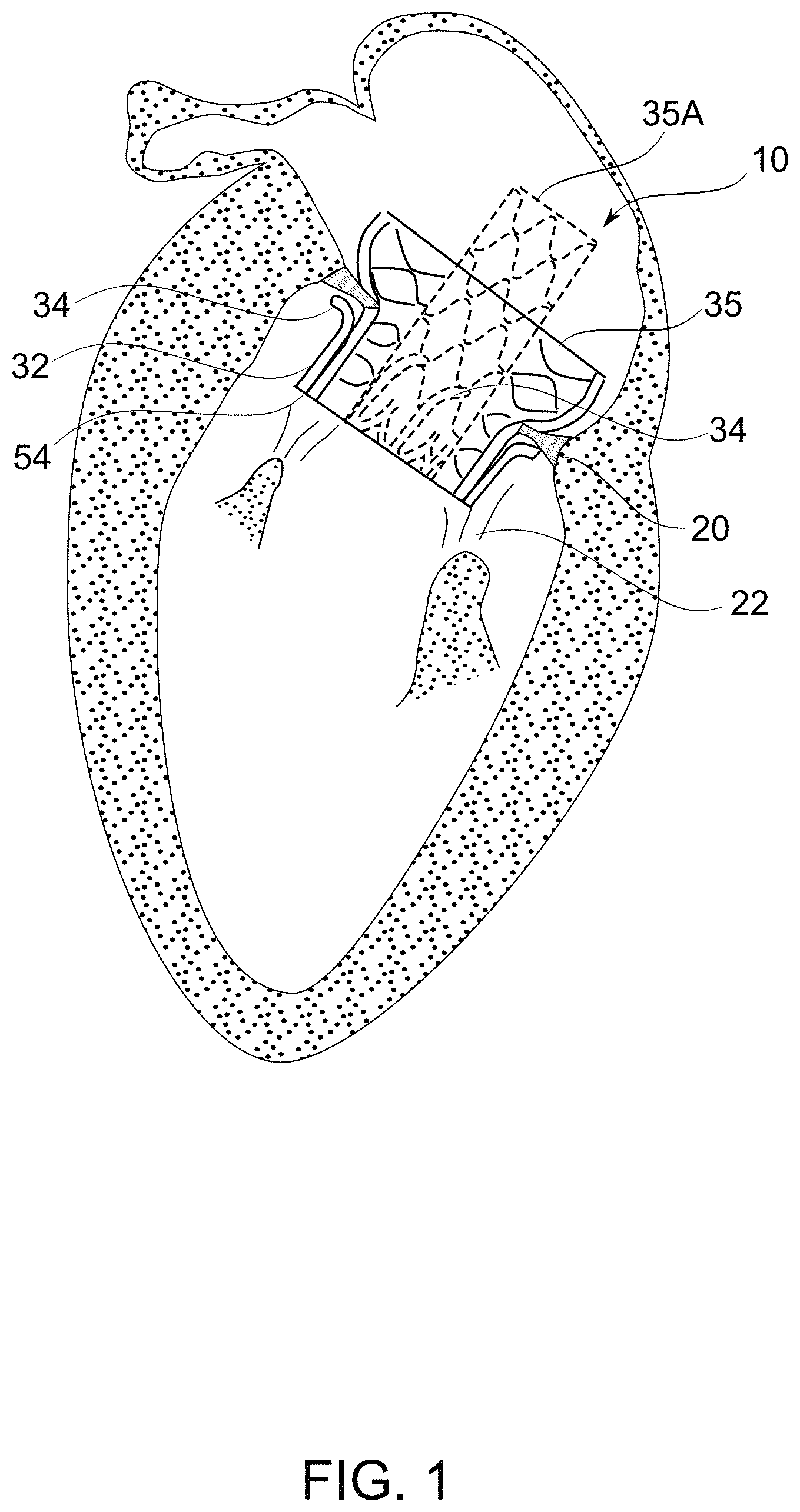Patent US11779459 Figure 1 – Frame for prosthetic valve