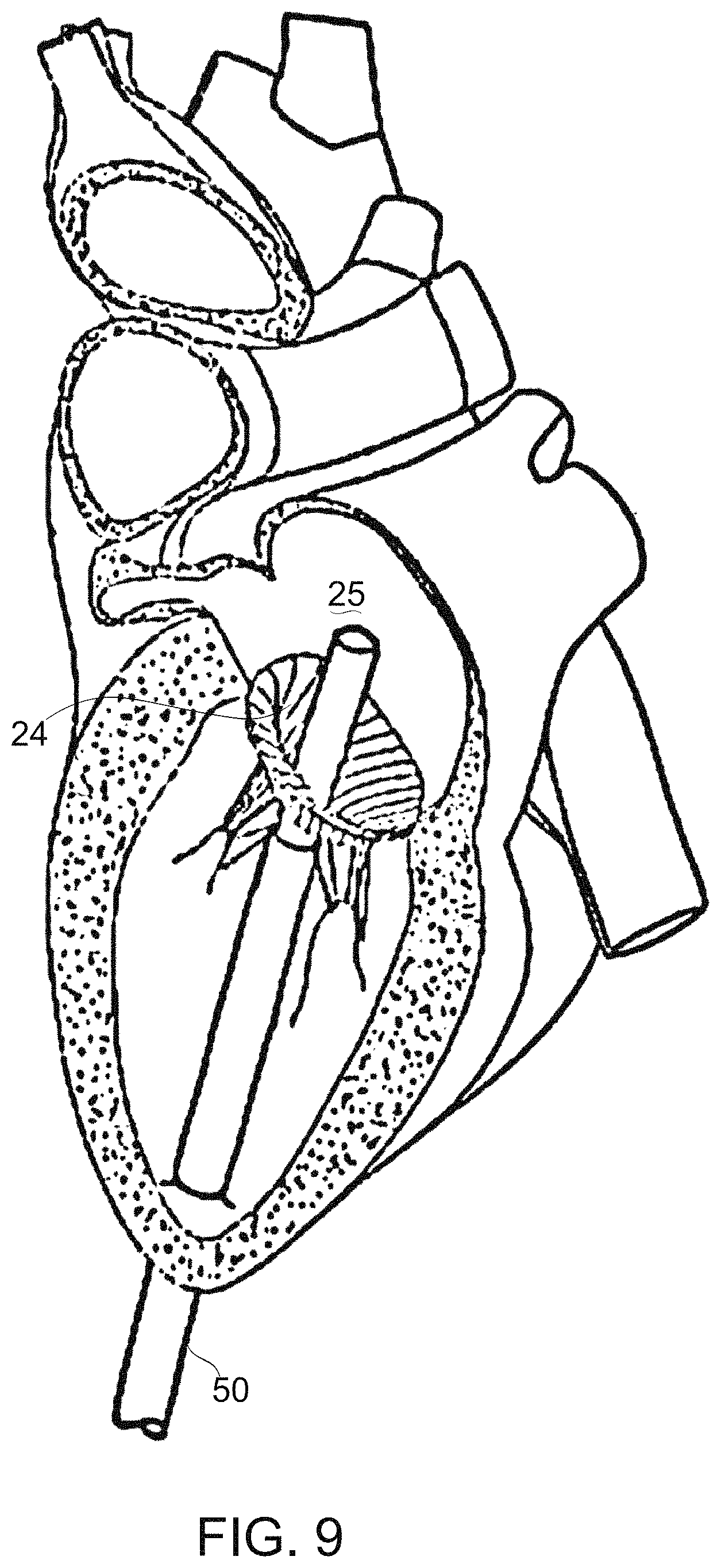 Patent US11779459 Figure 11 – Frame for prosthetic valve