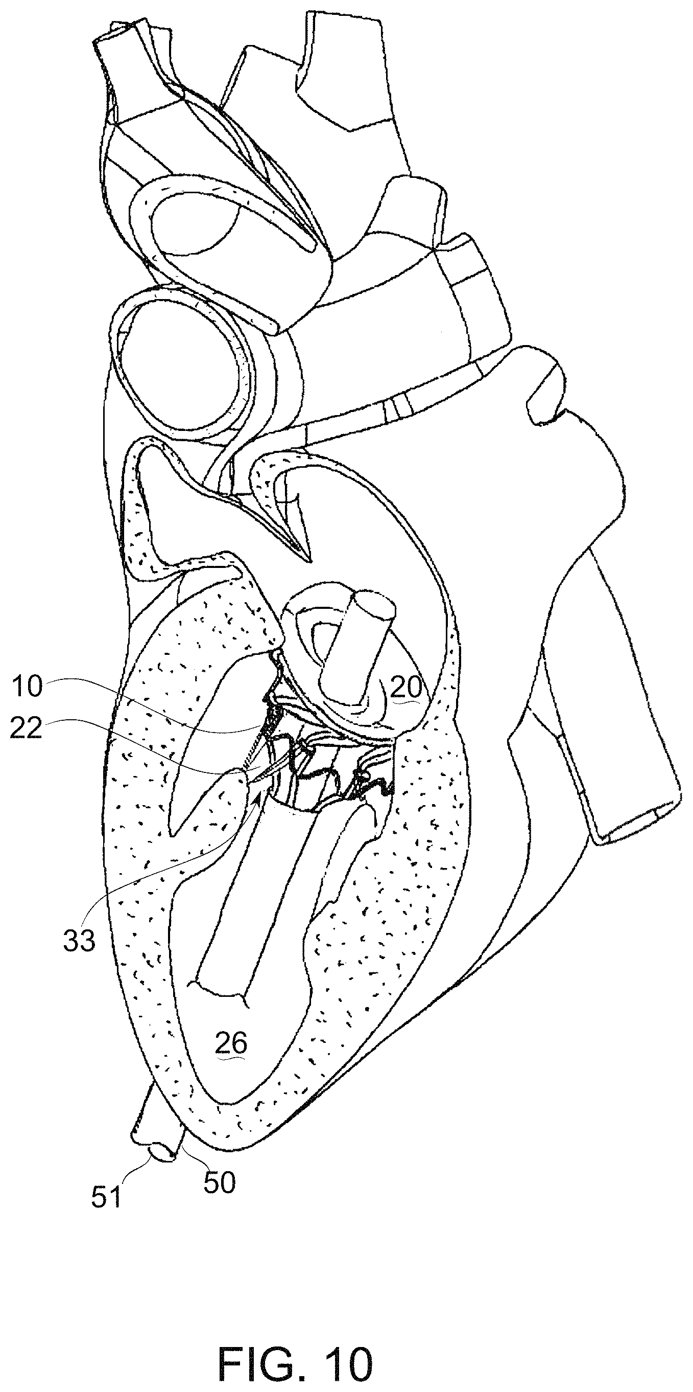 Patent US11779459 Figure 12 – Frame for prosthetic valve