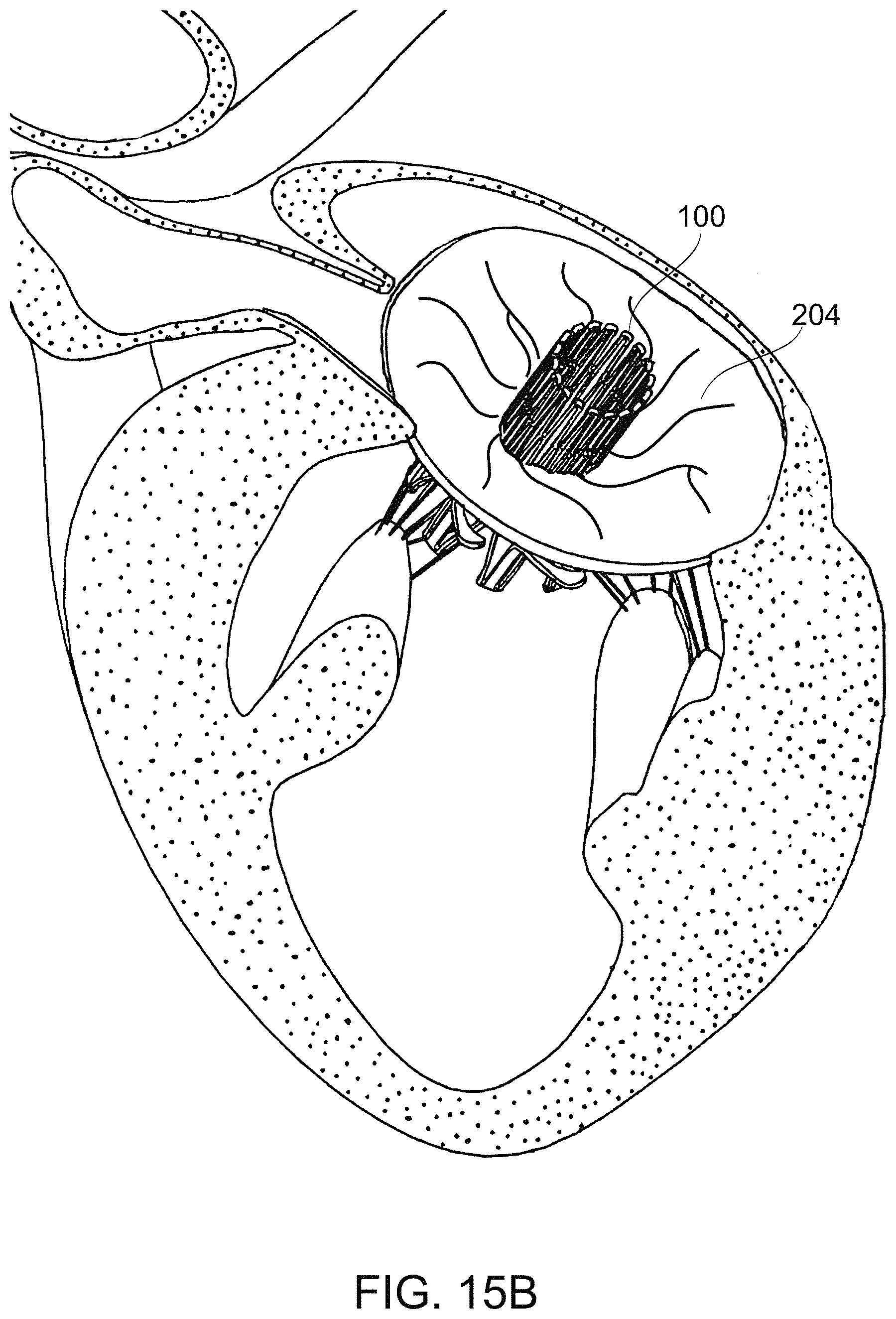 Patent US11779459 Figure 20 – Frame for prosthetic valve