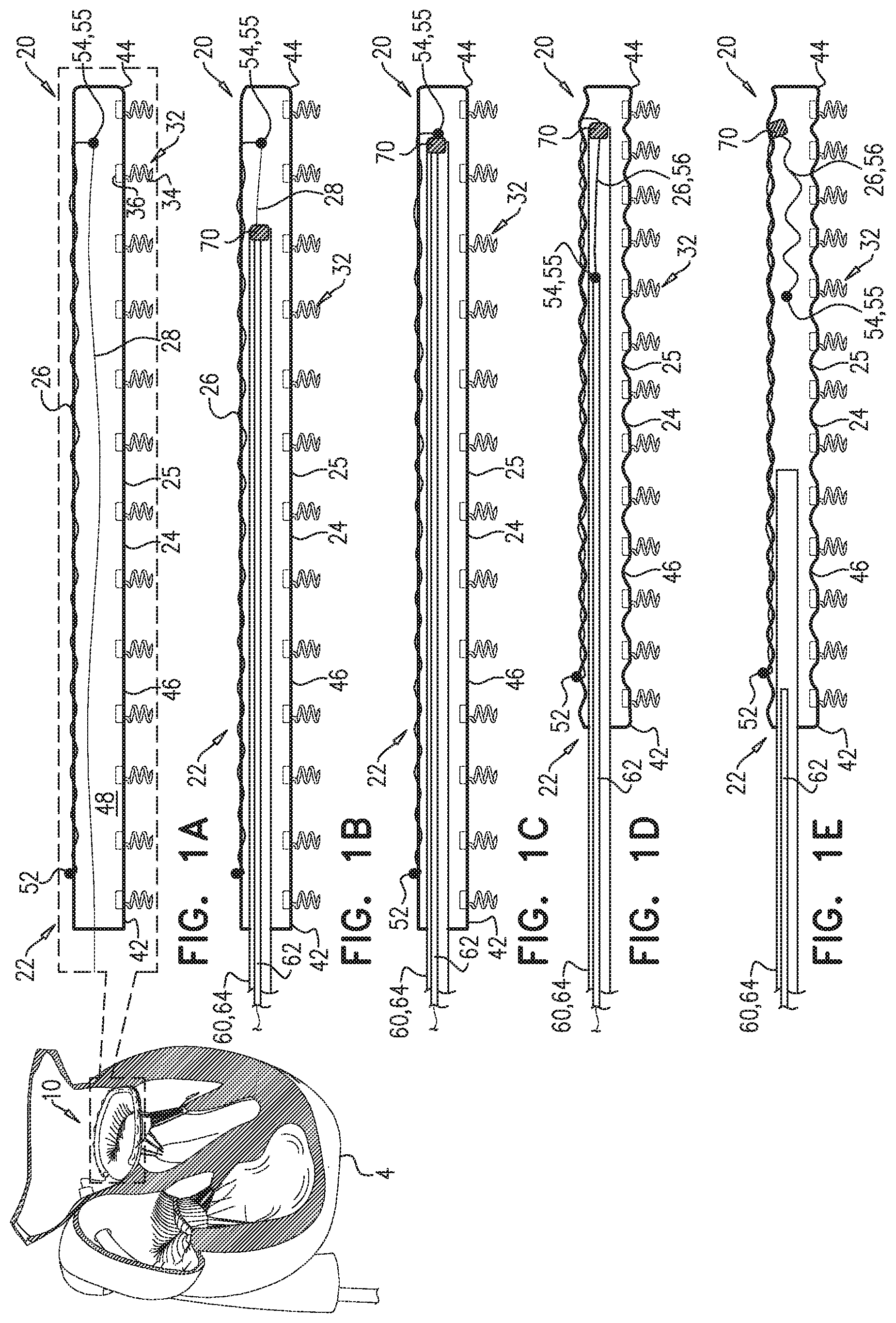 Patent US11779463 — Contraction of an annuloplasty structure — Figure 1