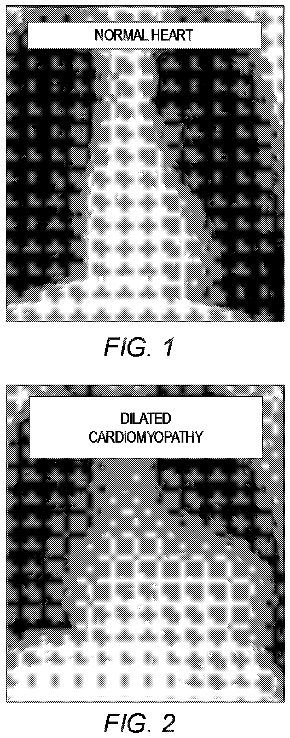 Patent US11779464 — Customized ventricular support device — Figure 1