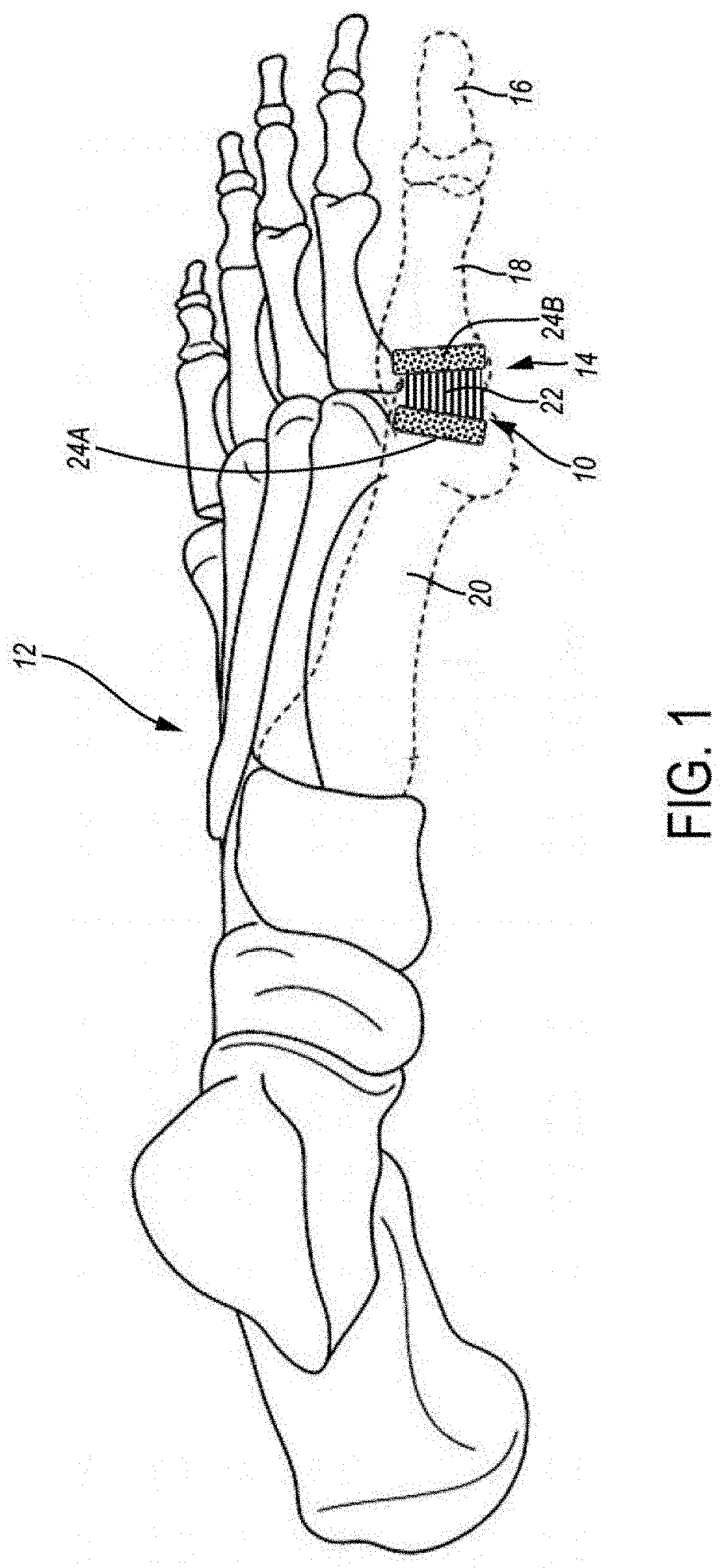 Patent US11779467 — Metarsophalangeal joint replacement device and methods — Figure 1