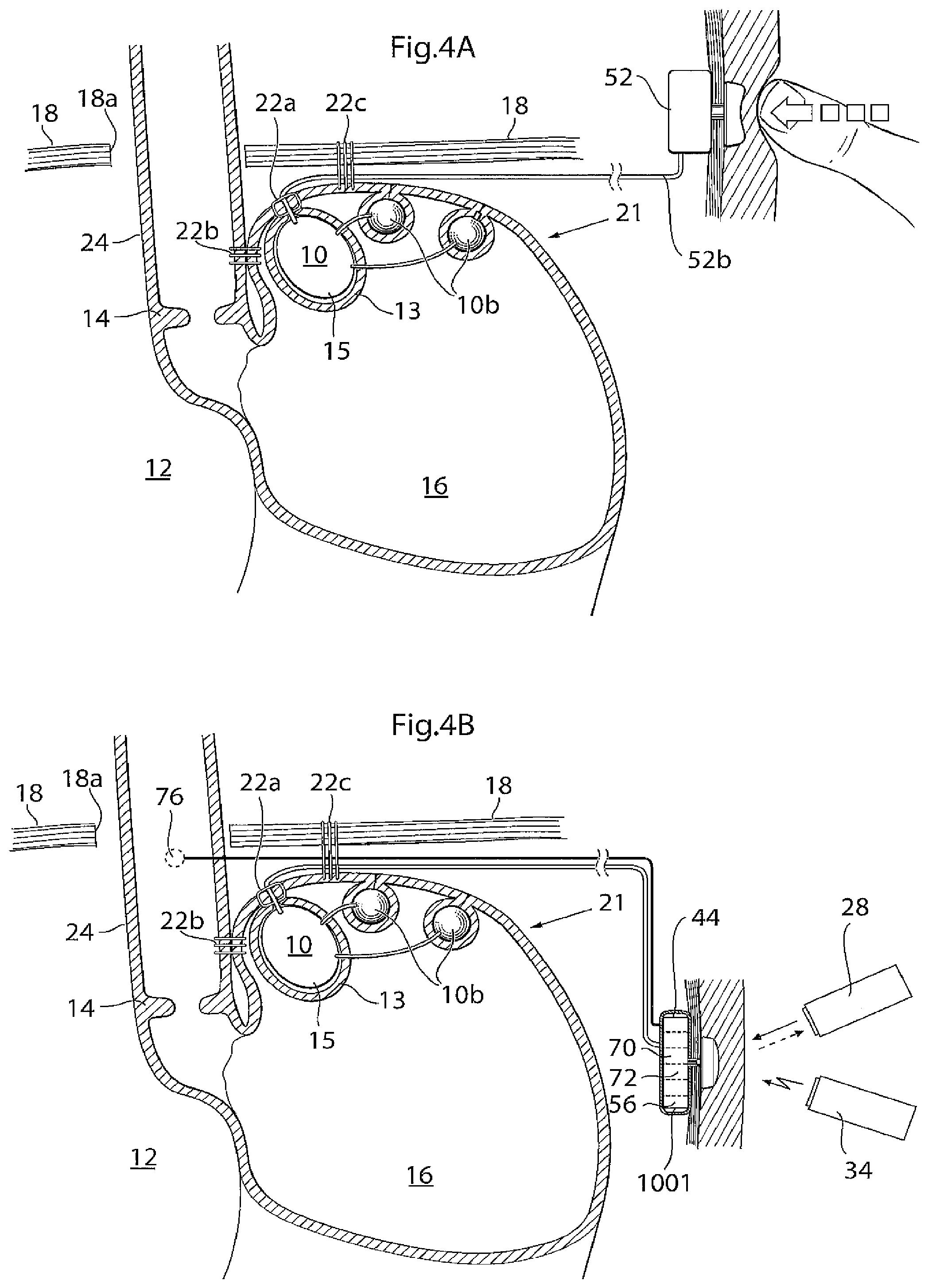 Patent US11779483 Figure 4 – Apparatus for treating GERD