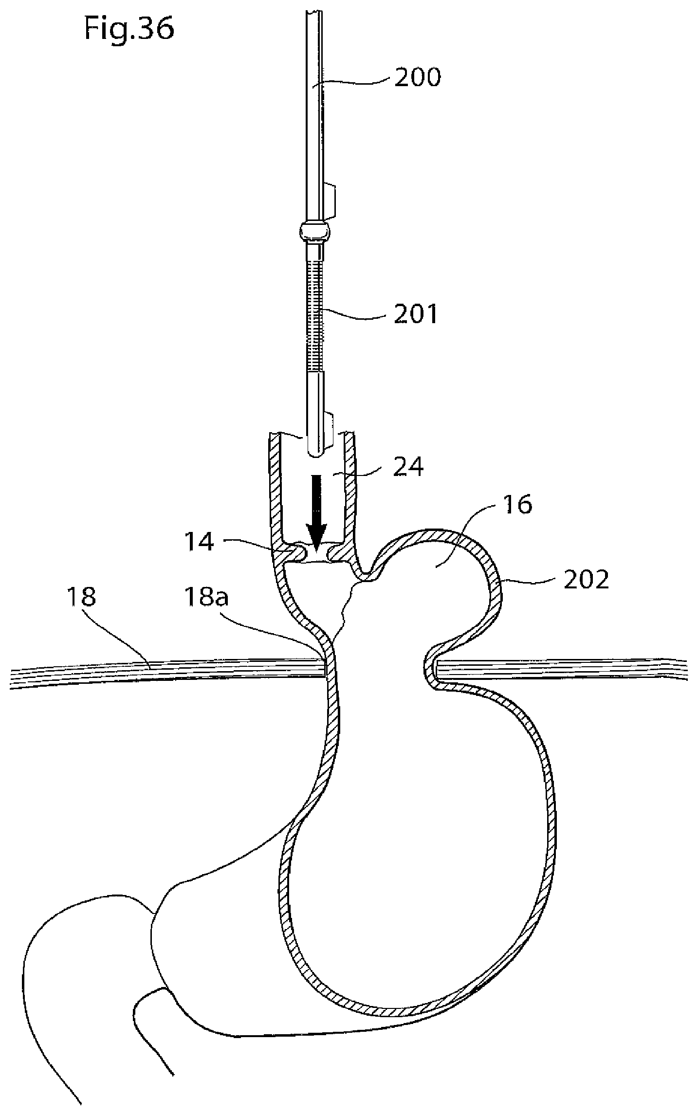 Patent US11779483 Figure 18 – Apparatus for treating GERD
