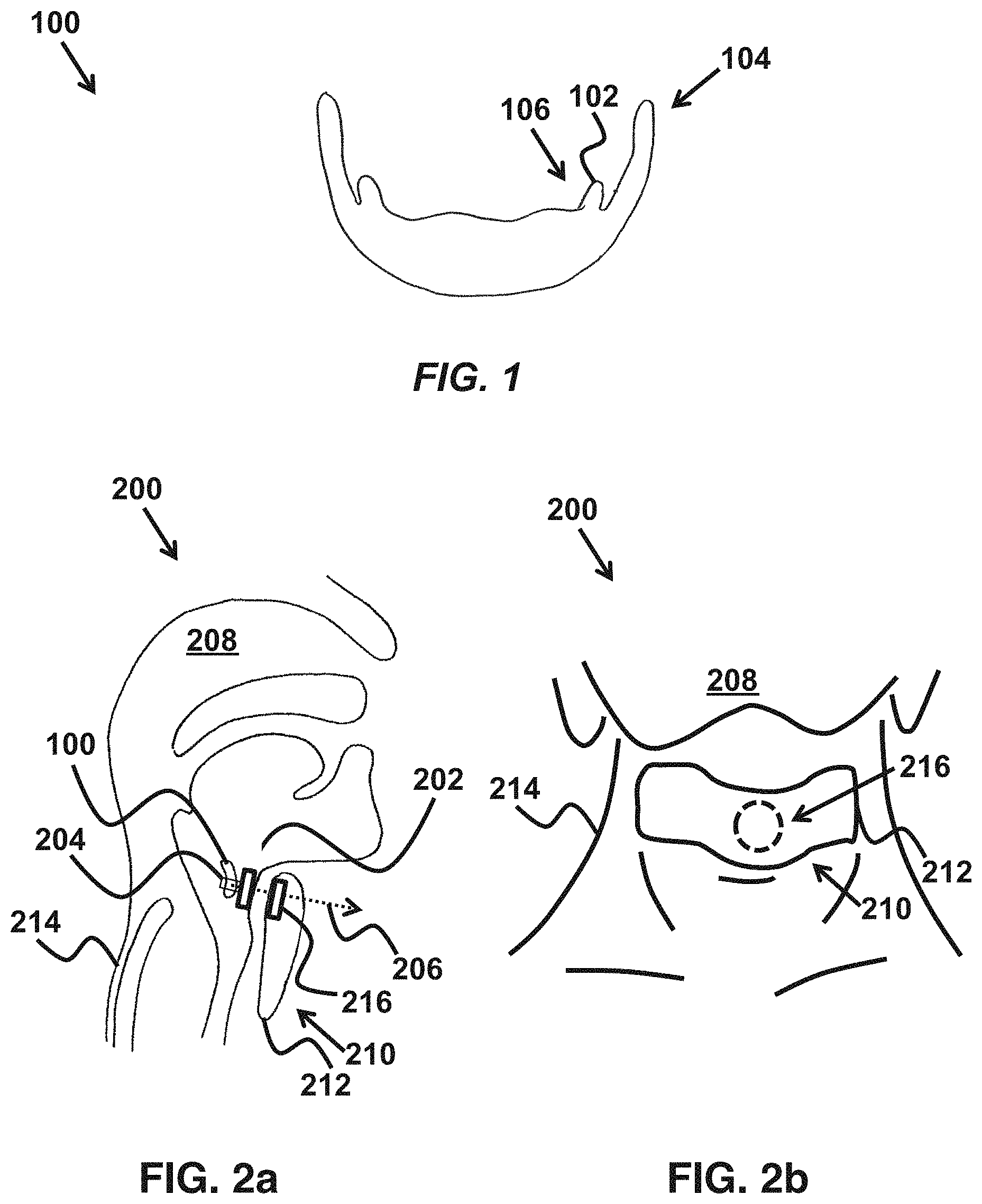 Patent US11779487 — Device and method for correcting obstructive sleep apnea — Figure 1