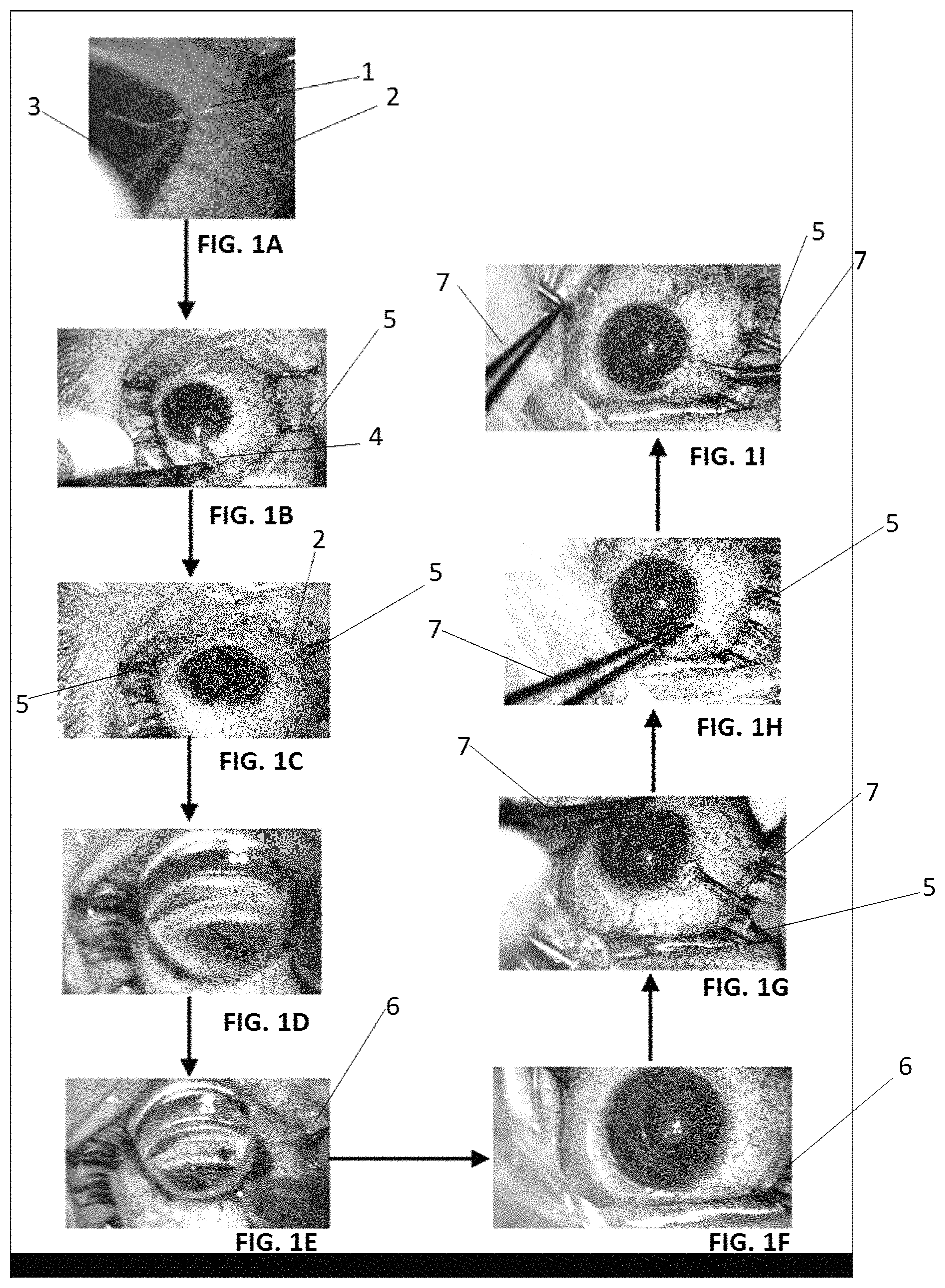 Patent US11779490 — Minimally invasive ab interno triple surgery for open-angle glaucoma — Figure 1