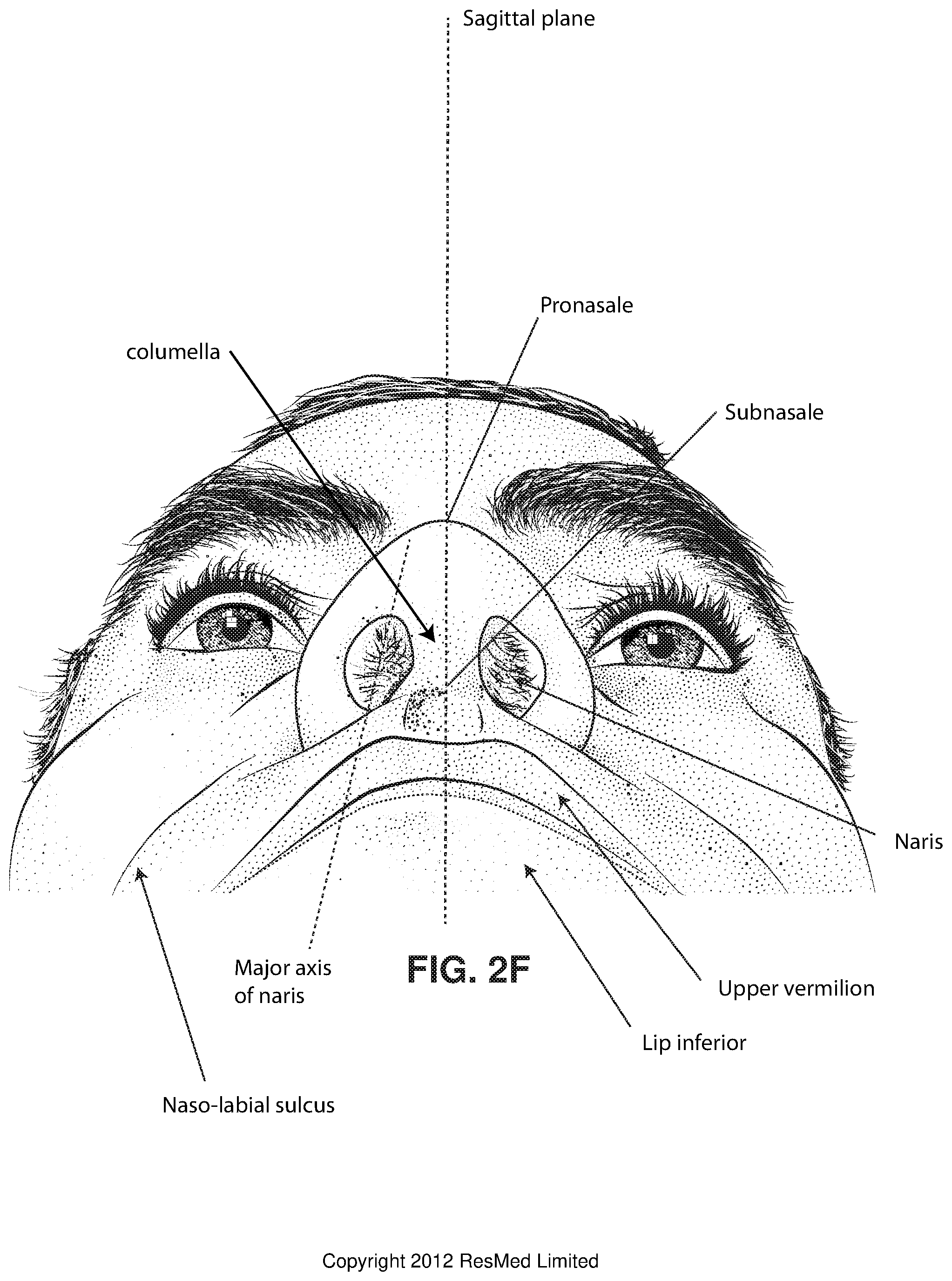 Patent US11779723 Figure 9 – Connector for positioning and stabilising structure
