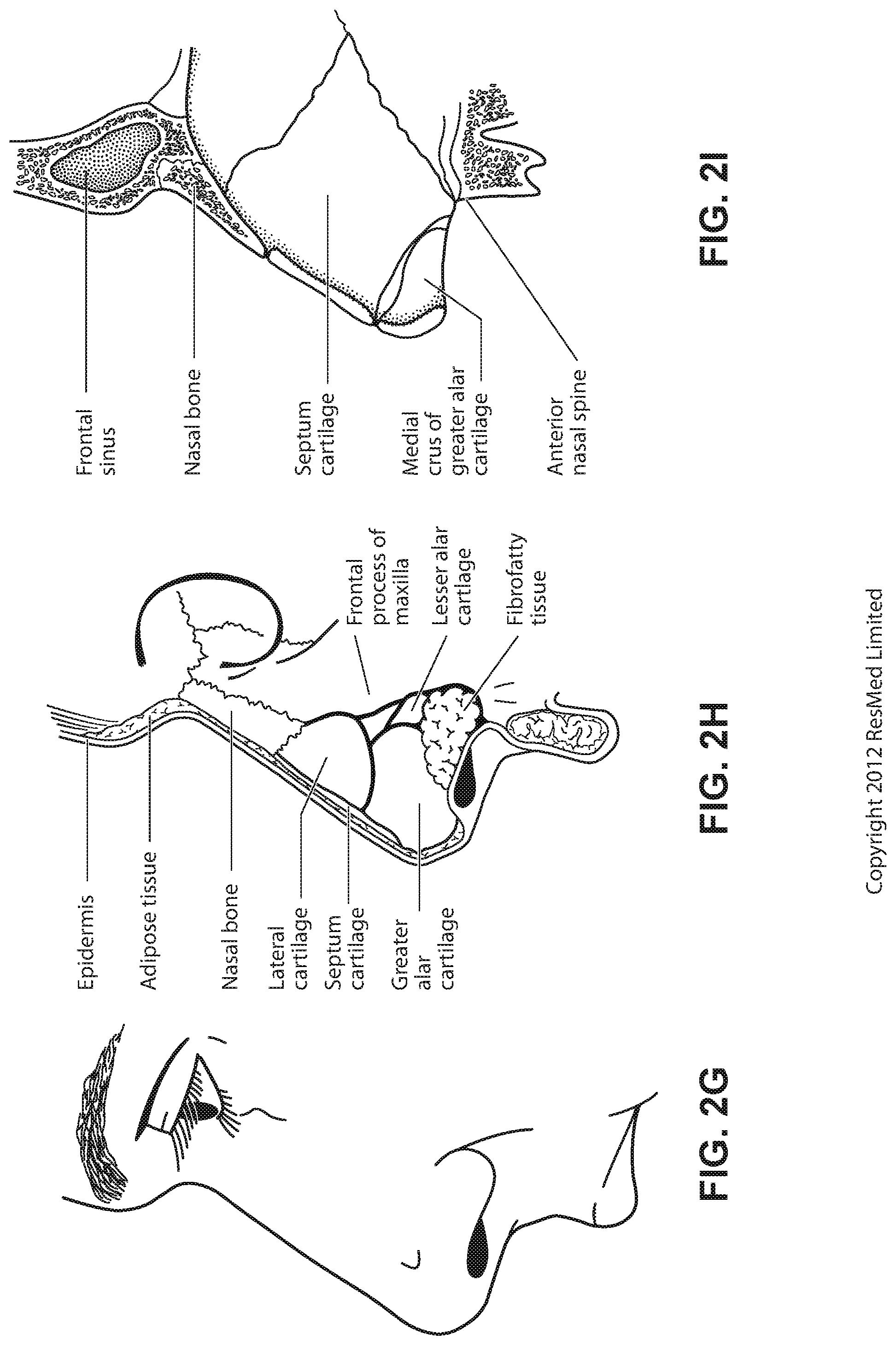 Patent US11779723 Figure 10 – Connector for positioning and stabilising structure