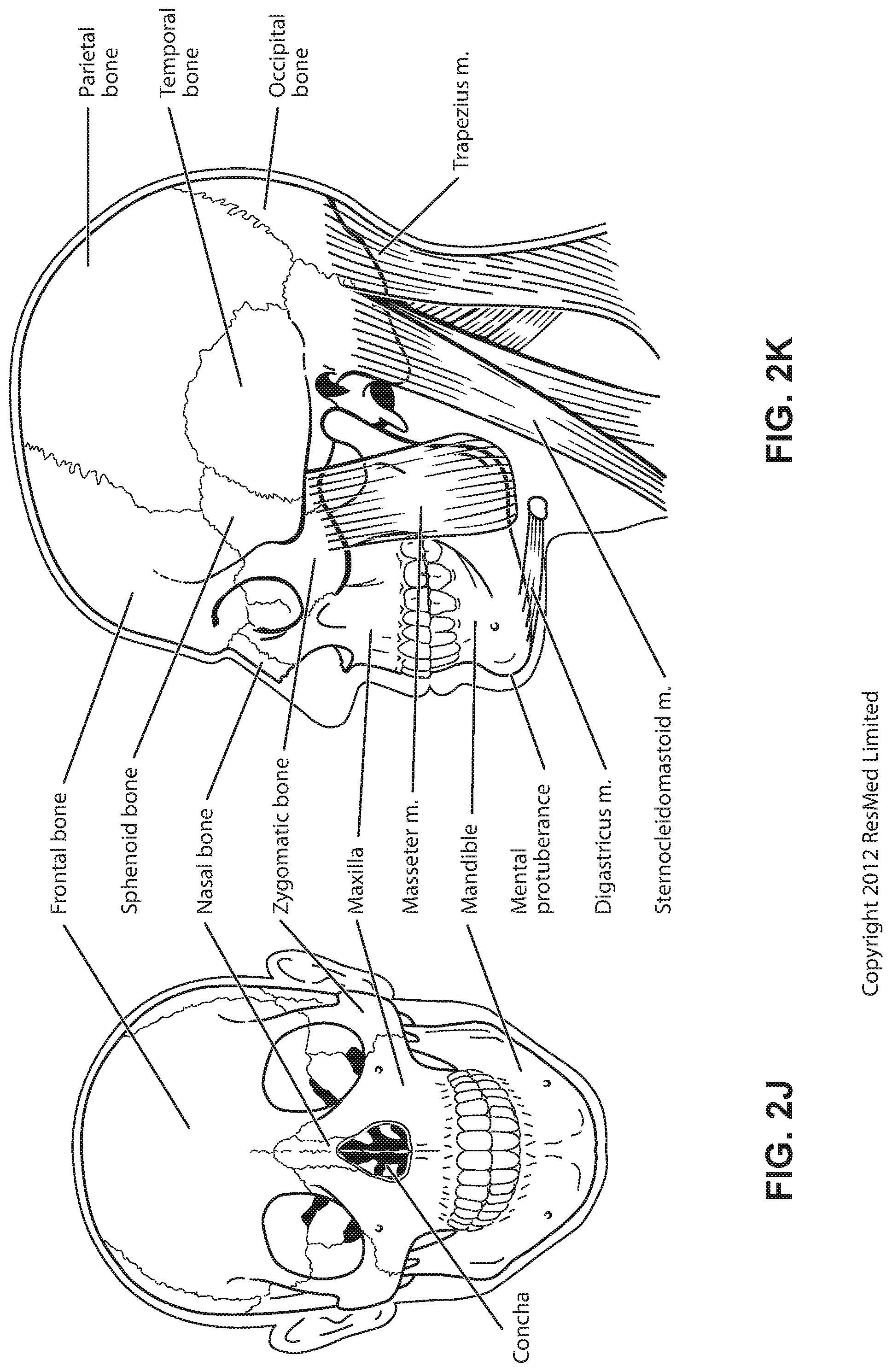 Patent US11779723 Figure 11 – Connector for positioning and stabilising structure