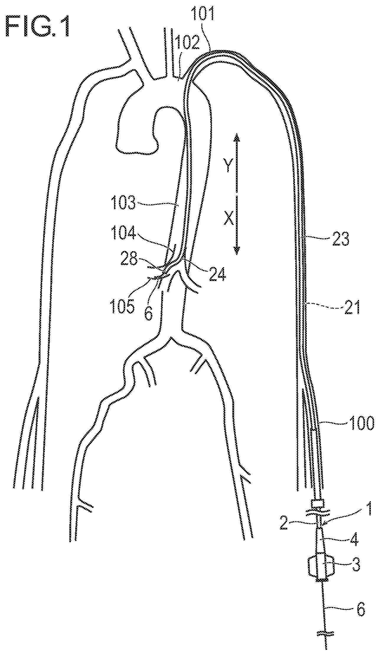 Patent US11779729 — Catheter and method of engaging catheter — Figure 1
