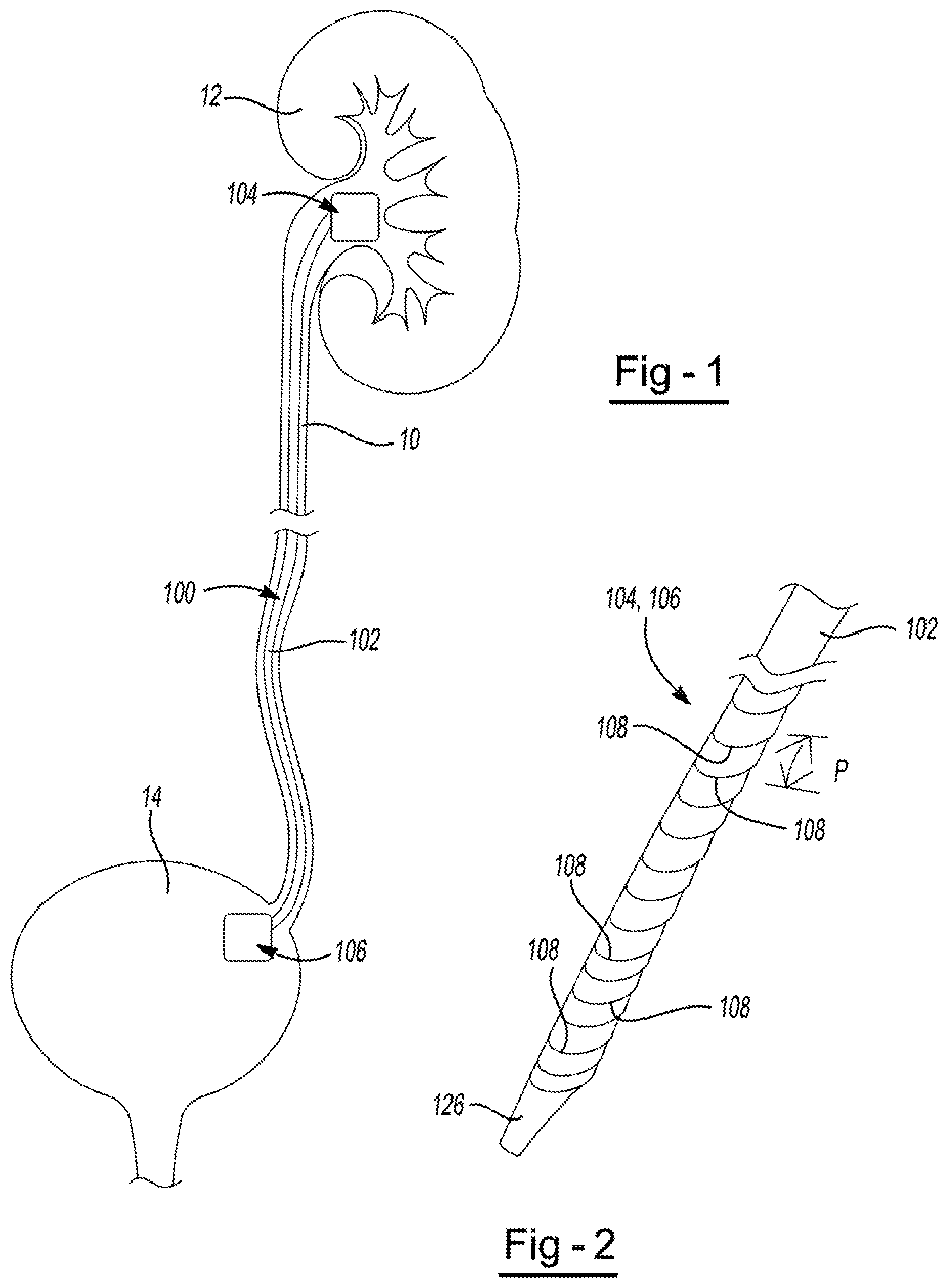 Patent US11779737 — Ureteral stent — Figure 1