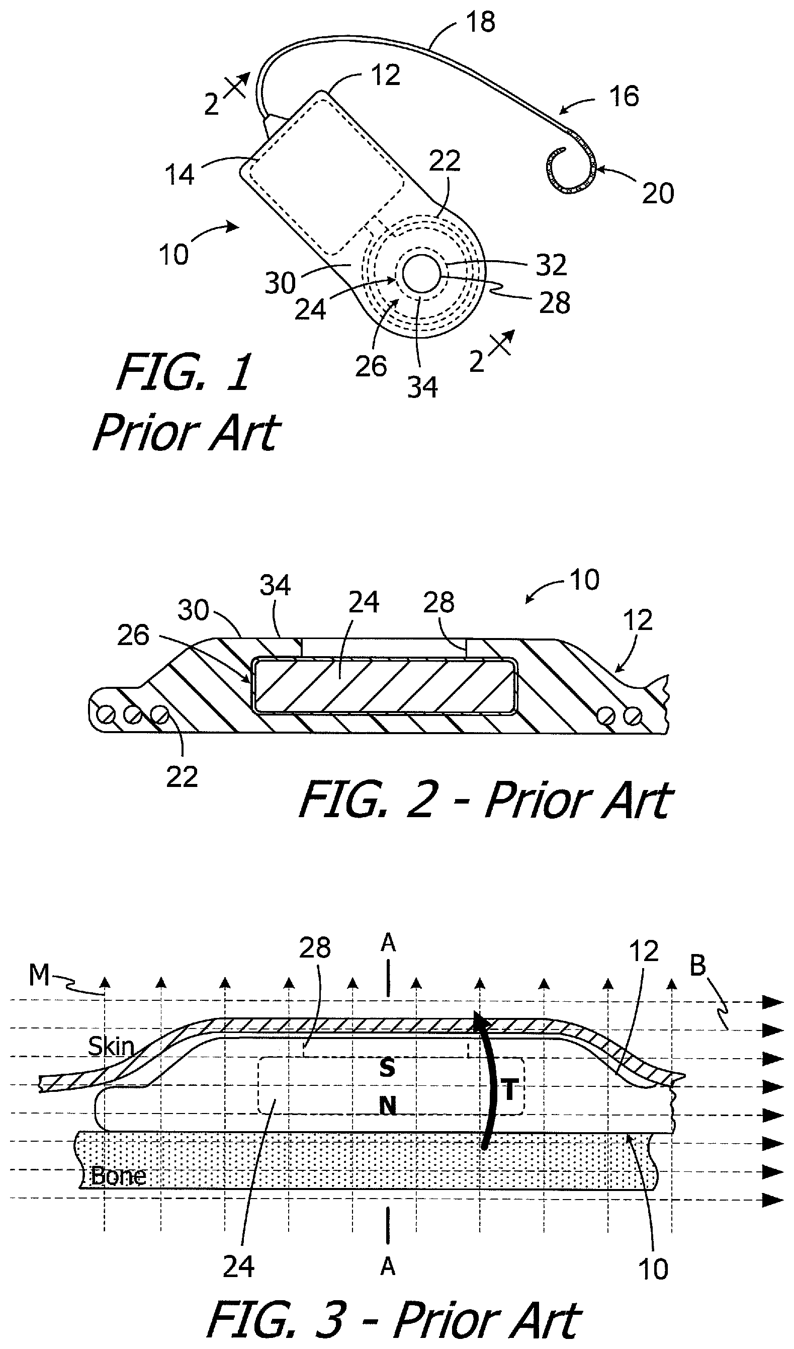 Patent US11779754 Figure 1 – Cochlear implants, magnets for use with same and magnet retrofit methods