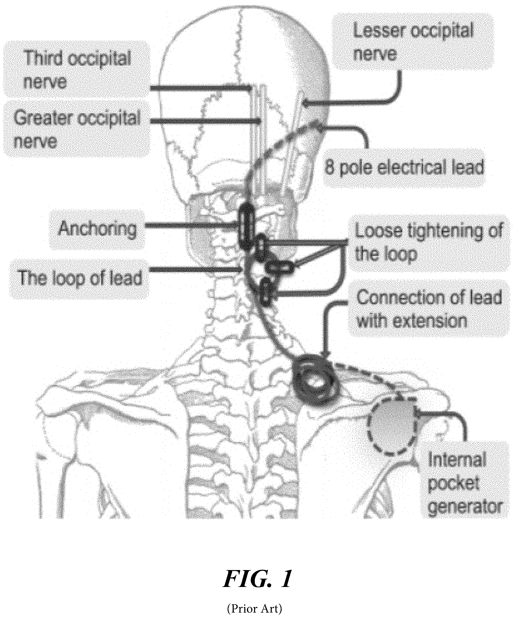 Patent US11779755 Figure 1 – System and methods for therapeutic stimulation