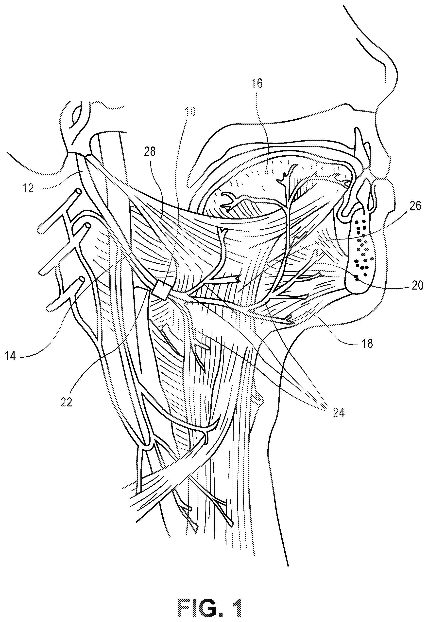 Patent US11779759 — Stimulator systems and methods for selectively recruiting fascicles in hypoglossal nerve trunk — Figure 1