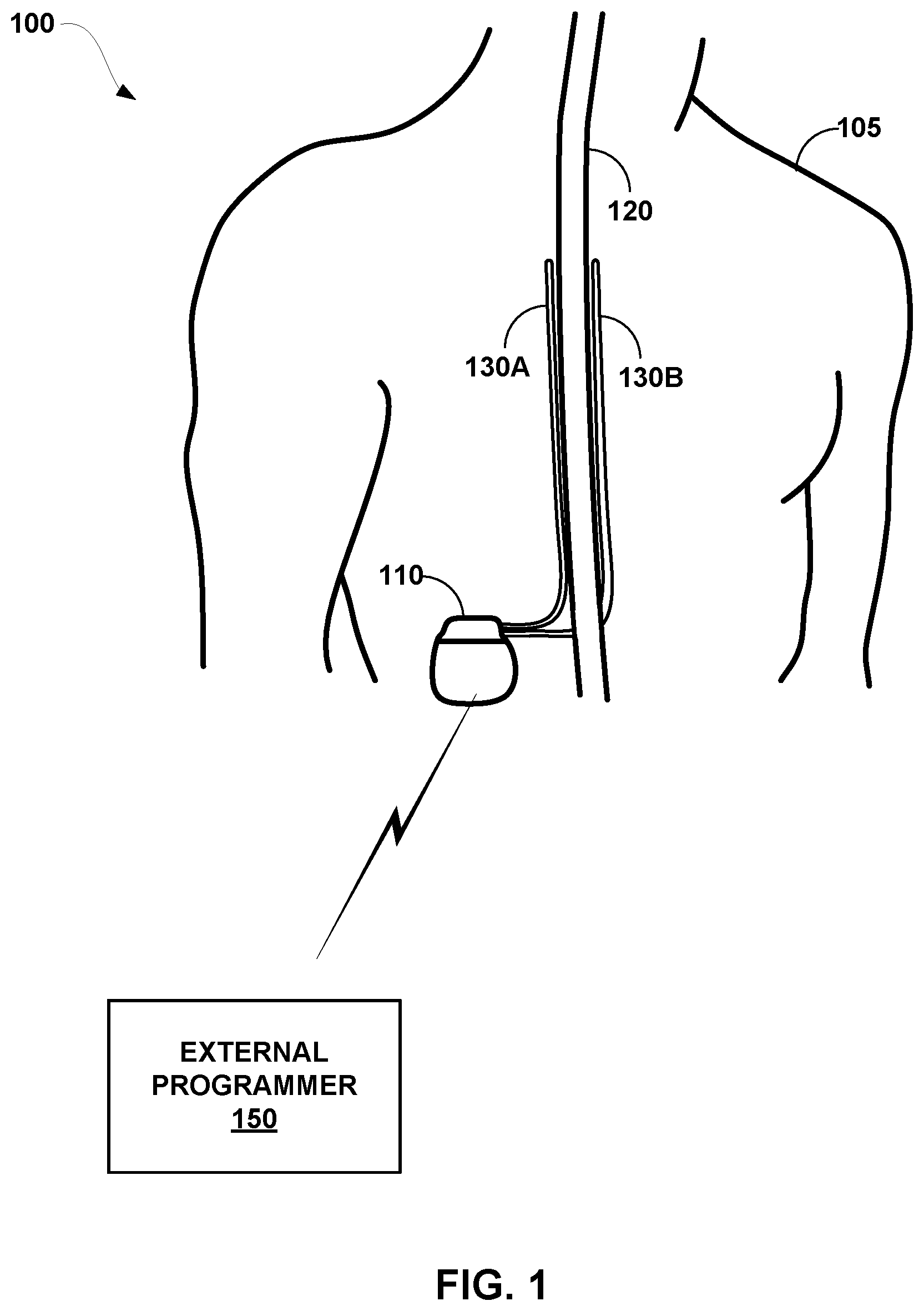 Patent US11779765 Figure 1 – Posture-based control of electrical stimulation therapy