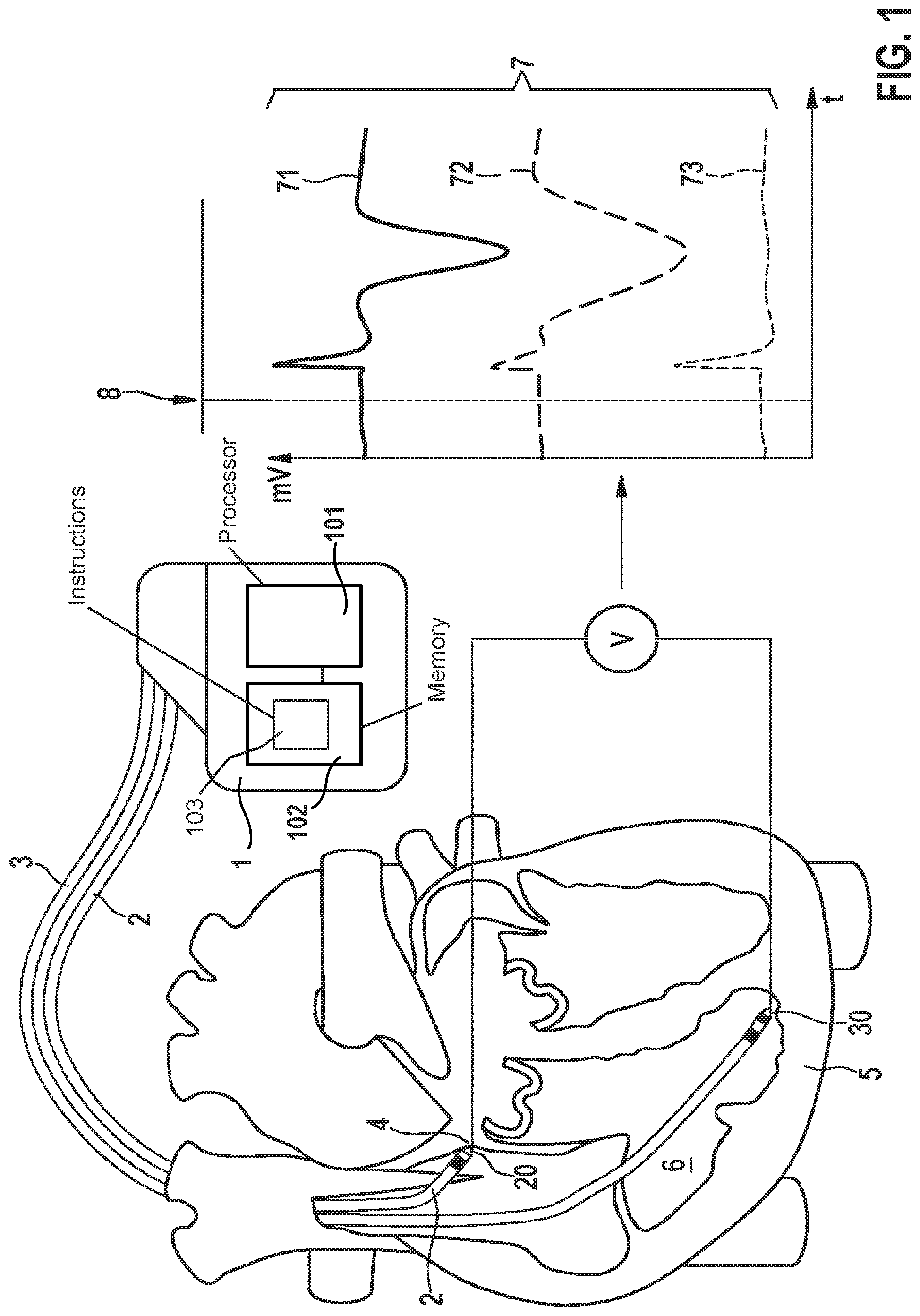Patent US11779771 — Implantable medical device for stimulating a human or animal heart employing an evaluation of signals between a His electrode and a further electrode — Figure 1