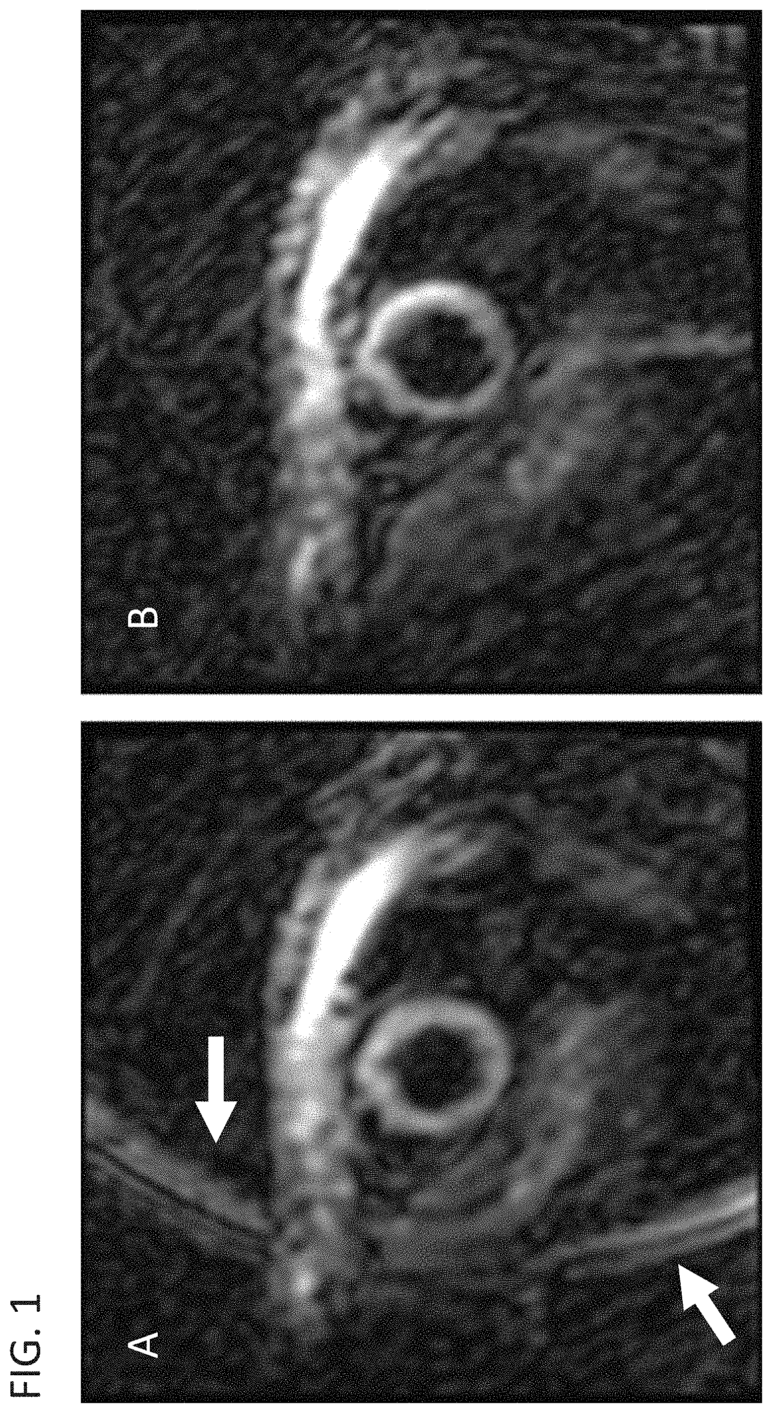 Patent US11782114 — Reducing artifact generation echo in stimulated-echo-based strain imaging — Figure 1